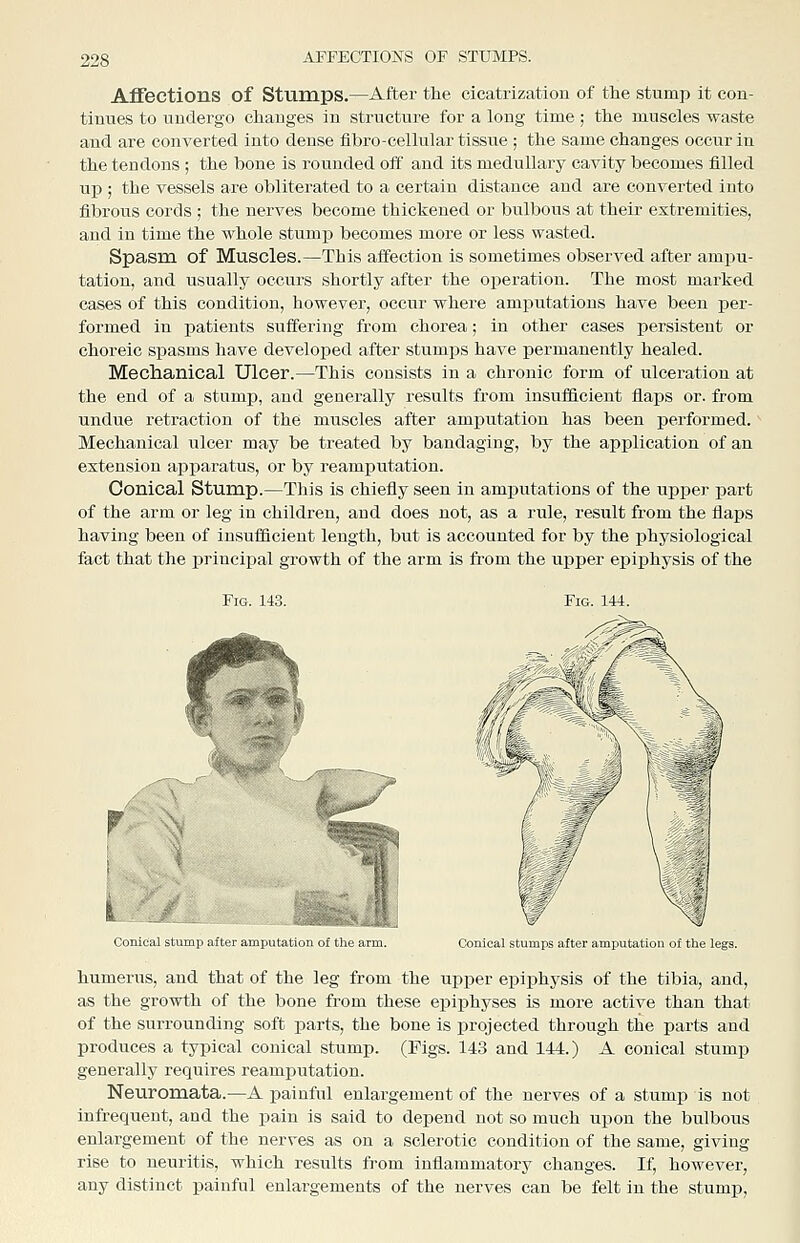 AFFECTIONS OF STUMPS. Affections of Stumps.—After the cicatrization of tlie stump it con- tinues to undergo cliauges in structure for a long time; the muscles waste and are converted into deuse fibro-cellular tissue; the same changes occur in the tendons ; the bone is rounded off and its medullary cavity becomes filled up ; the vessels are obliterated to a certain distance and are converted iuto fibrous cords ; the nerves become thickened or bulbous at their extremities, and in time the whole stump becomes more or less wasted. Spasm of Muscles.—This affection is sometimes observed after ampu- tation, and usually occurs shortly after the operation. The most marked cases of this condition, however, occur where amputations have been per- formed in patients suffering from chorea; in other cases persistent or choreic spasms have developed after stumps have permanently healed. Mechanical Ulcer.—This consists in a chronic form of ulceration at the end of a stump, and generally results from insufficient flaps or. from undue retraction of the muscles after amputation has been performed. Mechanical ulcer may be treated by bandaging, by the application of an extension apparatus, or by reamputation. Conical Stump.—This is chiefly seen in amj)utations of the upper part of the arm or leg in children, and does not, as a rule, result from the flaps having been of insufficieut length, but is accounted for by the physiological fact that the princiijal growth of the arm is from the upper epiphysis of the Fig. 143. f Conical stump after amputation of the arm. Conical stumps after amputation of the humerus, and that of the leg from the upper epiphysis of the tibia, and, as the growth of the bone from these epiphyses is more active than that of the surrounding soft parts, the bone is projected through the parts and produces a typical conical stump. (Figs. 143 and 144.) A conical stump generally requires reamputation. Neuromata.—A painful enlargement of the nerves of a stump is not infrequent, and the pain is said to depend not so much upon the bulbous enlargement of the nerves as on a sclerotic condition of the same, giving rise to neuritis, which results from inflammatory changes. If, however, any distinct painful enlargements of the nerves can be felt in the stump.