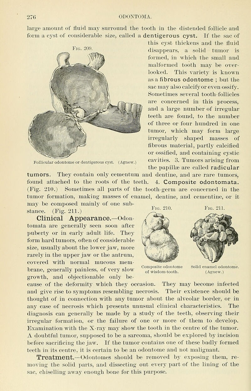 Follicular odontome or dentigerous cyst. (Agnew.) large amoimt of fluid may surround the tootli in the distended follicle and form a cj'st of considerable size, called a dentigerous cyst. If the sac of this cyst thickens and the fluid ^''^ ^^^ disappears, a solid tumor is formed, in which the small and malformed tooth may be over- looked. This variety is known as a fibrous odontome ; but the sac may also calcify or even ossify. Sometimes several tooth-follicles are concerned in this process, and a large number of irregular teeth are found, to the number of three or four hundred in one tumor, which may form large irregularly shaped masses of fibrous material, j)artly calcified or ossified, and containing cystic cavities. 3. Tumors arising from the papillae are called radicular tumors. They contain only cementum and dentine, and are rare tumors, found attached to the roots of the teeth. 4. Composite odontomata. (Fig. 210.) Sometimes all parts of the tooth-germ are concerned in the tumor formation, making masses of enamel, dentine, and cementine, or it may be composed mainly of one sub- stance. (Fig. 211.) Clinical Appearance.—Odon- tomata are generally seen soon after puberty or in early adult life. They form hard tumors, often of considerable size, usually about the lower jaw, more rarely in the upper jaw or the antrum, covered with normal mucous mem- brane, generally painless, of very slow growth, and objectionable only be- cause of the deformity which they occasion. They may become infected and give rise to symptoms resembling necrosis. Their existence should be thought of in connection with any tumor about the alveolar border, or in any case of necrosis which j)resents unusual clinical characteristics. The diagnosis can generally be made by a studj^ of the teeth, observing their irregular formation, or the failure of one or more of them to develop. Examination with the X-ray may show the tooth in the centre of the tumor. A doubtful tumor, supposed to be a sarcoma, should be explored by incision before sacrificing the jaw. If the tumor contains one of these badly formed teeth in its centre, it is certain to be an odontome and not malignant. Treatment.—Odontomes should be removed by exposing them, re- moving the solid parts, and dissecting out every part of the lining of the sac, chiselling away enough bone for this purpose. Fig. 210. Fig. 211. Composite odontome Solid enamel odontome.