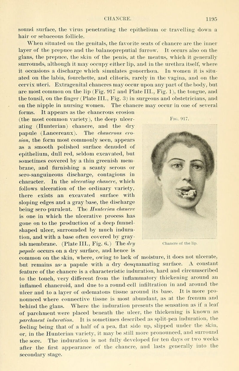 sound surface, tlie virus peuetrating the epithelium or travelling down a hair or sebaceous follicle. When situated on the genitals, the favorite seats of chancre are the inner layer of the i^repuce and the balanopreputial furrow. It occurs also on the glans, the prepuce, the skin of the penis, at the meatus, which it generally surrounds, although it may occupy either lip, and in the urethra itself, where it occasions a discharge which simulates gonorrh(]6a. In women it is situ- ated on the labia, fourchette, and clitoris, rarely in the vagina, and on the cervix uteri. Extragenital chancres may occur upon any part of the body, but are most common on the lip (Fig. 917 and Plate III., Fig. 1), the tongue, and the tonsil, on the iinger (Plate III., Fig. 3) in surgeons and obstetricians, and on the nipple in nursing women. The chancre may occur in one of several forms. It appears as the chancrous erosion (the most common variety), the deep ulcer- Fig. 917. ating (Hunterian) chancre, and the dry pajjule (Lancereaux). The chancrous ero- sion, the form most commonly seen, appears as a smooth polished surface denuded of epithelium, dull red, seldom excavated, but sometimes covered by a thin greenish mem- brane, and furnishing a scanty serous or sero-sanguineous discharge, contagious in character. In the ulcerating chancre, which follows ulceration of the ordinary variety, there exists an excavated surface with sloping edges and a gray base, the discharge being sero-purulent. The Hunterian chancre is one in which the ulcerative i^rocess has gone on to the production of a deep funnel- shaped ulcer, surrounded by much indura- tion, and with a base often covered by gray- ish membrane. (Plate III., Fig. 6.) The dry chancre of the up. papule occurs on a dry surface, and hence is common on the skin, where, owing to lack of moisture, it does not ulcerate, but remains as- a papule with a dry desquamating surface. A constant feature of the chancre is a characteristic induration, hard and circumscribed to the touch, very different from the inflammatory thickening around an inflamed chancroid, and due to a round-cell infiltration in and around the ulcer and to a layer of cedematous tissue around its base. It is more pro- nounced where connective tissue is most abundant, as at the frenum and behind the glans. Where the induration presents the sensation as if a leaf of parchment were placed beneath the ulcer, the thickening is known as parchment induration. It is sometimes described as split-pea induration, the feeling being that of a half of a pea, flat side up, slipped under the skin, or, in the Hunterian variety, it may be still more pronounced, and surround the sore. The induration is not fully de^'eloped for ten days or two weeks after the first appearance of the chancre, and lasts generally into the secondary stage.