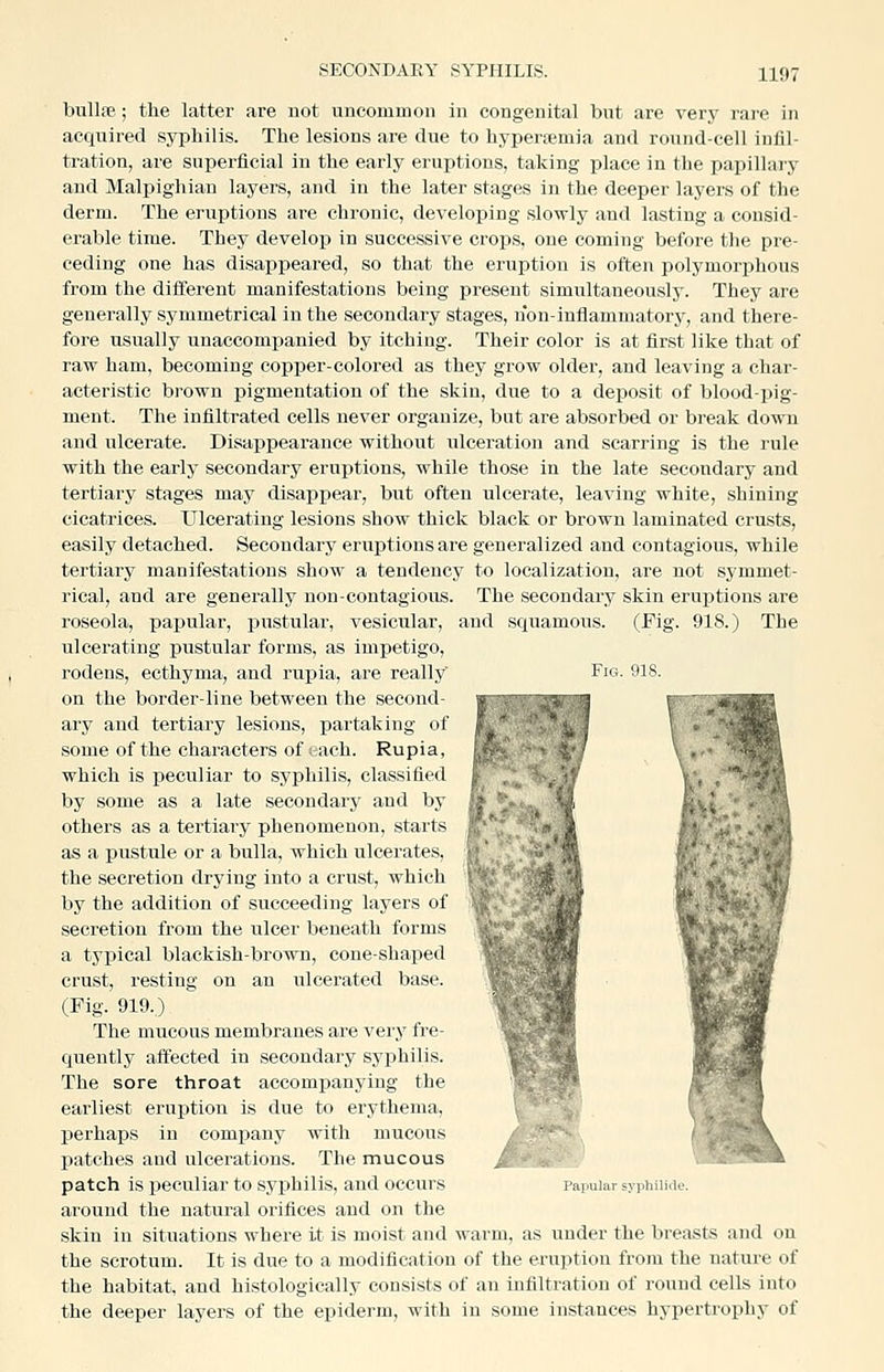 bullfe; the latter are not uncommon in congenital but are very rare in acquired syphilis. The lesions are due to hypertemia and round-cell infil- tration, are superficial in the early eruptions, taking place in the papillary and Malpighian layers, and in the later stages in the deeper layers of the derm. The eruptions are chronic, developing slowly and lasting a consid- erable time. They develop in successive crops, one coming before the pre- ceding one has disappeared, so that the eruption is often polymorphous from the different manifestations being i^resent simultaneously. They are generally symmetrical in the secondary stages, non-inflammatory, and there- fore usually unaccompanied by itching. Their color is at first like that of raw ham, becoming copper-colored as they grow older, and leaving a char- acteristic brown pigmentation of the skin, due to a deposit of blood-pig- ment. The infiltrated cells never organize, but are absorbed or break down and ulcerate. Disappearance withoiat ulceration and scarring is the rule with the early secondary eruptions, while those in the late secondary and tertiary stages may disappear, but often ulcerate, leaving white, shining cicatrices. Ulcerating lesions show thick black or brown laminated crusts, easily detached. Secondary eruptions are generalized and contagious, while tertiary manifestations show a tendency to localization, are not symmet- rical, and are generally non-contagious. The secondary skin eruptions are roseola, papular, pustular, vesicular, and squamous. (Fig. 918.) The ulcerating pustular forms, as impetigo, rodens, ecthyma, and rupia, are really Fig. 918. on the border-line between the second- ary and tertiary lesions, partaking of some of the characters of each. Rupia, which is peculiar to syphilis, classified by some as a late secondary and by others as a tertiary phenomenon, starts as a pustule or a bulla, which ulcerates, the secretion drying into a crust, which by the addition of succeeding layers of secretion from the ulcer beneath forms a typical blackish-brown, cone-shaped crust, resting on an ulcerated base. (Fig. 919.) The mucous membranes are very fre- quently affected in secondary syphilis. The sore throat accompanying the earliest eruption is due to erythema, perhaps in comjiany with mucous patches and ulcerations. The mucous patch is ijeculiar to syphilis, and occurs around the natural orifices and on the skin in situations where it is moist and warm, as under the breasts and on the scrotum. It is due to a modification of the eruption from the nature of the habitat, and histologically consists of an infiltration of round cells into the deeper layers of the epiderm, with in some instances hypertrophy of Papular syphilide.