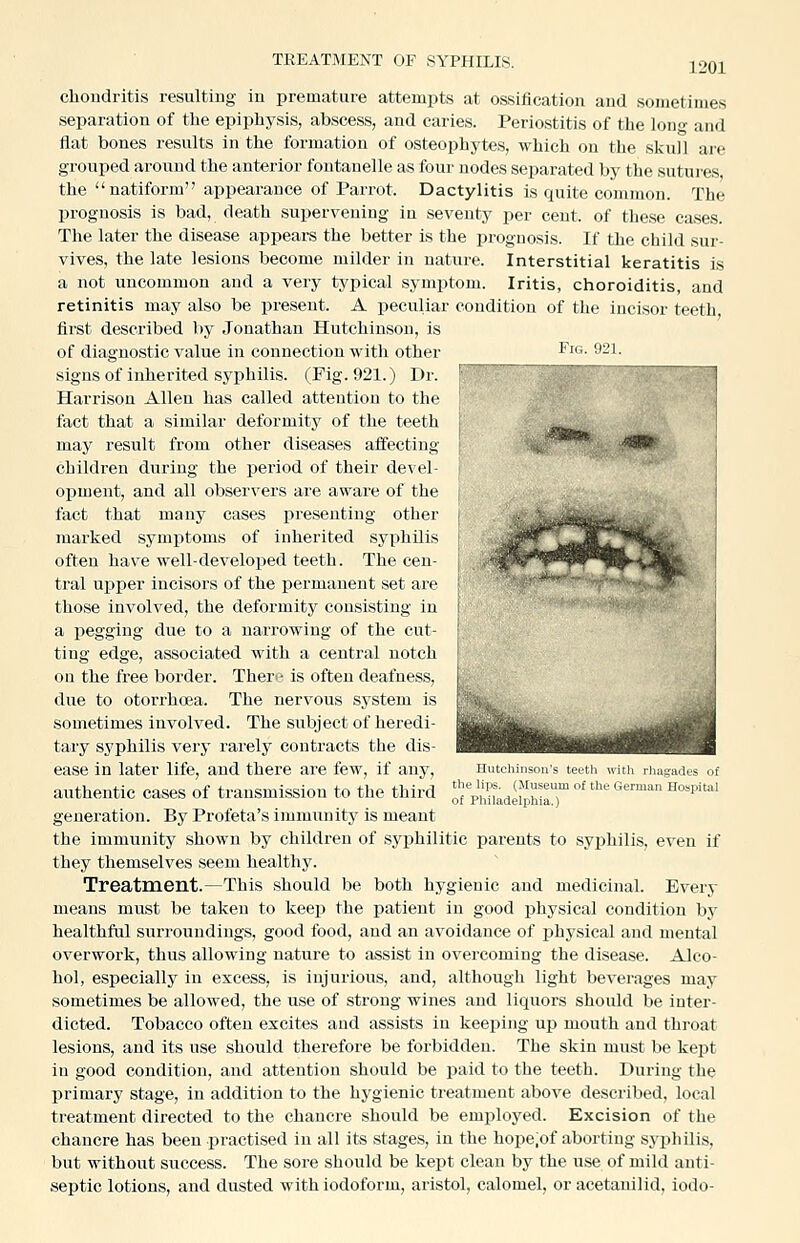 Fig. 921. chondritis resulting in premature attempts at ossification and sometimes separation of the epiphysis, abscess, and caries. Periostitis of the long and flat bones results in the formation of osteophytes, which on the skull are grouped around the anterior fontanelle as foui' nodes separated by the sutures the natiform appearance of Parrot. Dactylitis is quite common. The prognosis is bad, death supervening in seventy per cent, of these cases. The later the disease appears the better is the prognosis. If the child sur- vives, the late lesions become milder in nature. Interstitial keratitis is a not uncommon and a very typical symptom. Iritis, choroiditis, and retinitis may also be present. A peculiar condition of the incisor teeth first described by Jonathan Hutchinson, is of diagnostic value in connection with other signs of inherited syphilis. (Fig. 921.) Dr. Harrison Allen has called attention to the fact that a similar deformity of the teeth may result from other diseases affecting children during the period of their devel- opment, and all observers are aware of the fact that many cases presenting other marked symptoms of inherited syphilis often have well-developed teeth. The cen- tral upper incisors of the permanent set are those involved, the deformity consisting in a pegging due to a narrowing of the cut- ting edge, associated with a central notch on the free border. There is often deafness, due to otorrhcea. The nervous system is sometimes involved. The subject of heredi- tary syphilis very rarely contracts the dis- ease in later life, and there are few, if any, aiithentic cases of transmission to the third generation. By Profeta's immunity is meant the immunity shown by children of syphilitic parents to syphilis, even if they themselves seem healthy. Treatment.—This should be both hygienic and medicinal. Every means must be taken to keep the patient in good jjhysical condition by healthful surroundings, good food, and an avoidance of physical and mental overwork, thus allowing nature to assist in overcoming the disease. Alco- hol, especially in excess, is injurious, and, although light beverages may sometimes be allowed, the use of strong wines and liquors should be inter- dicted. Tobacco often excites aud assists in keeping up mouth and thi-oat lesions, and its use should therefore be forbidden. The skin must be kept in good condition, and attention should be paid to the teeth. During the primary stage, in addition to the hygienic treatment above described, local treatment directed to the chancre should be employed. Excision of the chancre has been practised in all its stages, in the hope,of aborting sj'ijhilis. but without success. The sore should be kept clean by the use of mild anti- septic lotions, and dusted with iodoform, aristol, calomel, or acetanilid, iodo- Hutchinson's teeth with rhagades of the lips. (Museum of the German Hospital of Philadelphia.)