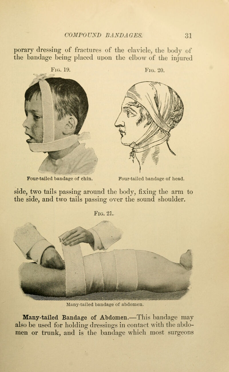 porary dressing of fractures of the clavicle, the body of the bandage being placed upon the elbow of the injured Fig. 19. Four-tailed bandage of chin. Fig. 20. Four-tailed bandage of head. side, two tails passing around the body, fixing the arm to the side, and two tails passing over the sound shoulder. Fig. 21. 4 Many-tailed bandage of abdomen. Many-tailed Bandage of Abdomen.—This bandage may also be used for holding dressings in contact with the abdo- men or trunk, and is the bandage which most surgeons