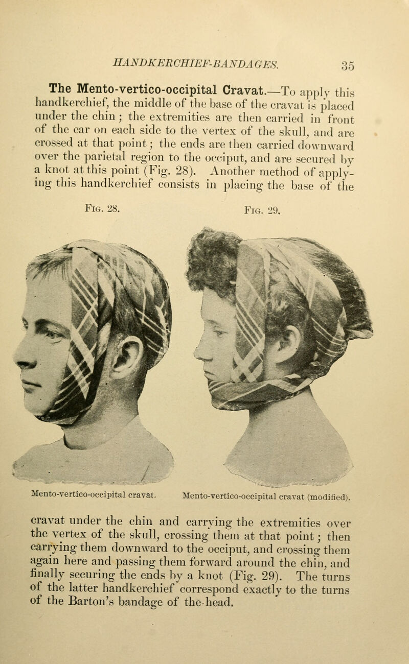 The Mento-vertico-occipital Cravat.—To apply this handkerchief, the middle of the base of the cravat is placed under the chin ; the extremities are then carried in front of the ear on each side to the vertex of the skull, and are crossed at that point; the ends are then carried downward over the parietal region to the occiput, and are secured by a knot at this point (Fig. 28). Another method of apply- ing this handkerchief consists in placing the base of the Fig. 28. Fig. 29. Mento-vertico-occipital cravat. Mento-vertico-occipital cravat (modified). cravat under the chin and carrying the extremities over the vertex of the skull, crossing them at that point; then carrying them downward to the occiput, and crossing them again here and passing them forward around the chin, and finally securing the ends by a knot (Fig. 29). The turns of the latter handkerchief correspond exactly to the turns of the Barton's bandage of the head.