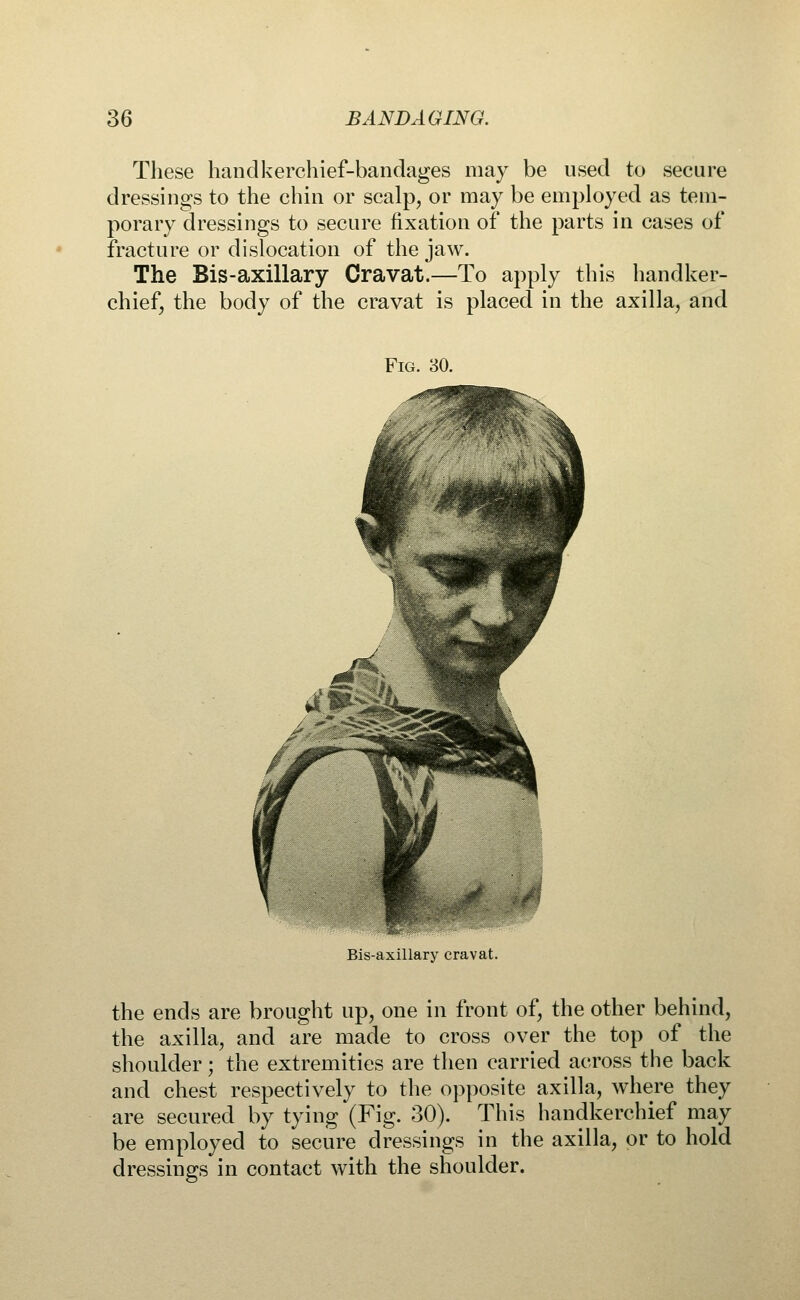 These handkerchief-bandages may be used to secure dressings to the chin or scalp, or may be employed as tem- porary dressings to secure fixation of the parts in cases of fracture or dislocation of the jaw. The Bis-axillary Cravat.—To apply this handker- chief, the body of the cravat is placed in the axilla, and Fig. 30. Bis-axillary cravat. the ends are brought up, one in front of, the other behind, the axilla, and are made to cross over the top of the shoulder; the extremities are then carried across the back and chest respectively to the opposite axilla, where they are secured by tying (Fig. 30). This handkerchief may be employed to secure dressings in the axilla, or to hold dressings in contact with the shoulder.