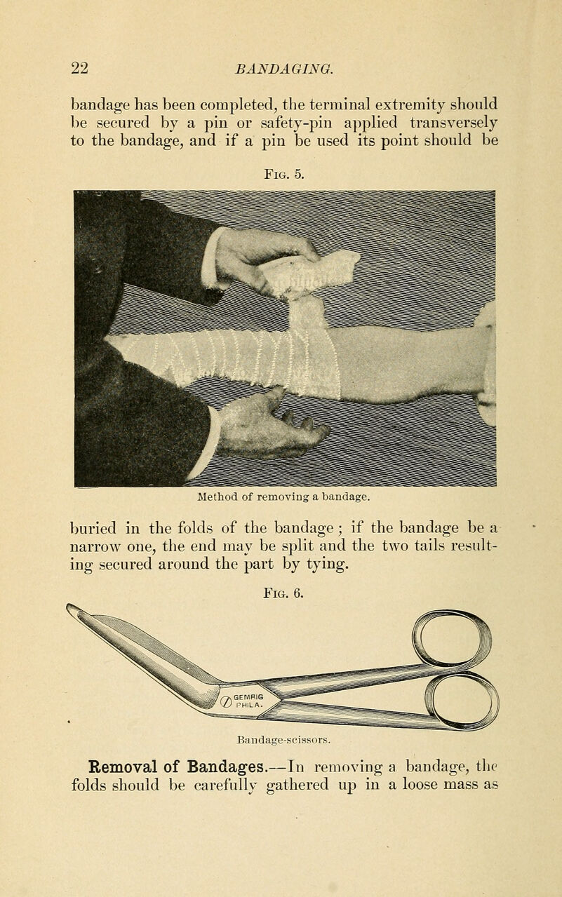 bandage has been completed, the terminal extremity should be secured by a pin or safety-pin applied transversely to the bandage, and if a pin be used its point should be Fig. 5. Method of removiug a bandage. buried in the folds of the bandage; if the bandage be a narrow one, the end may be split and the two tails result- ing secured around the part by tying. Fig. 6. Bandage-scissors. Removal of Bandages.—In removing a bandage, the folds should be carefully gathered up in a loose mass as