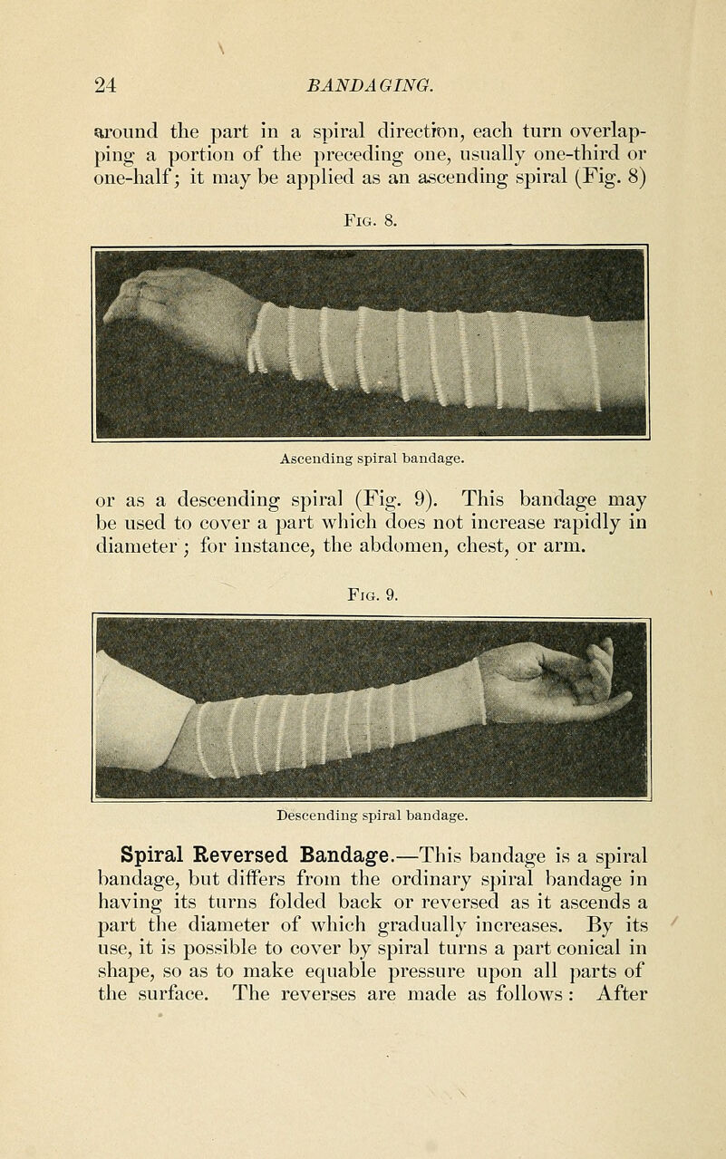 around the part in a spiral direction, each turn overlap- ping a portion of the preceding one, usually one-third or one-half; it may be applied as an ascending spiral (Fig. 8) Fig. 8. Ascending spiral bandage. or as a descending spiral (Fig. 9). This bandage may be used to cover a part which does not increase rapidly in diameter ; for instance, the abdomen, chest, or arm. Descending spiral bandage. Spiral Reversed Bandage.—This bandage is a spiral bandage, but diifers from the ordinary spiral bandage in having its turns folded back or reversed as it ascends a part the diameter of which gradually increases. By its use, it is possible to cover by spiral turns a part conical in shape, so as to make equable pressure upon all parts of the surface. The reverses are made as follows : After