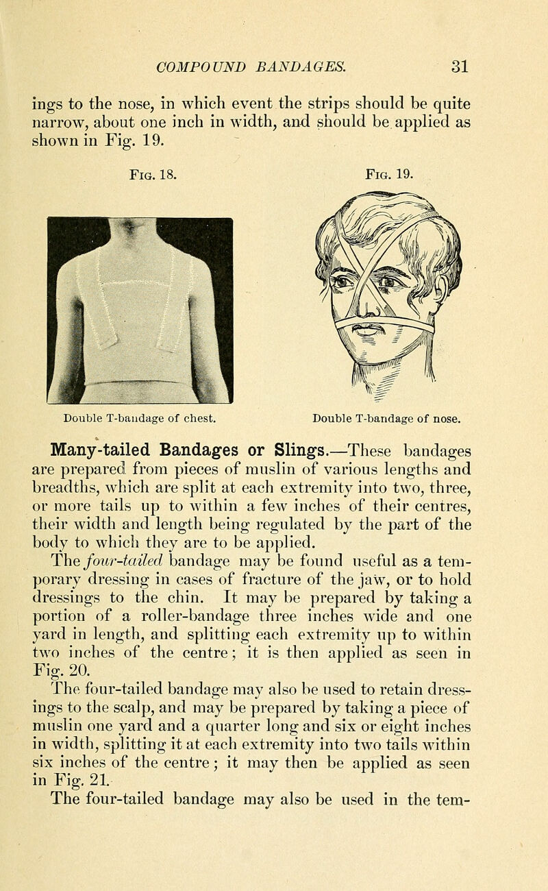 ings to the nose, in which event the strips should be quite narrow, about one inch in width, and should be applied as shown in Fig. 19. Fig. 18. Fig. 19. Double T-baudage of chest. Double T-baridage of nose. Many-tailed Bandages or Slings.—These bandages are prepared from pieces of muslin of various lengths and breadths, which are split at each extremity into two, three, or more tails up to within a few inches of their centres, their width and length being regulated by the part of the body to which they are to be applied. The foiir-tailed bandage may be found useful as a tem- porary dressing in cases of fracture of the jaw, or to hold dressings to the chin. It may be prepared by taking a portion of a roller-bandage three inches wide and one yard in length, and splitting each extremity up to within two inches of the centre; it is then applied as seen in Fig. 20. The four-tailed bandage may also be used to retain dress- ings to the scalp, and may be prepared by taking a piece of muslin one yard and a quarter long and six or eight inches in width, splitting it at each extremity into two tails M'ithin six inches of the centre; it may then be applied as seen in Fig. 21. The four-tailed bandage may also be used in the tern-