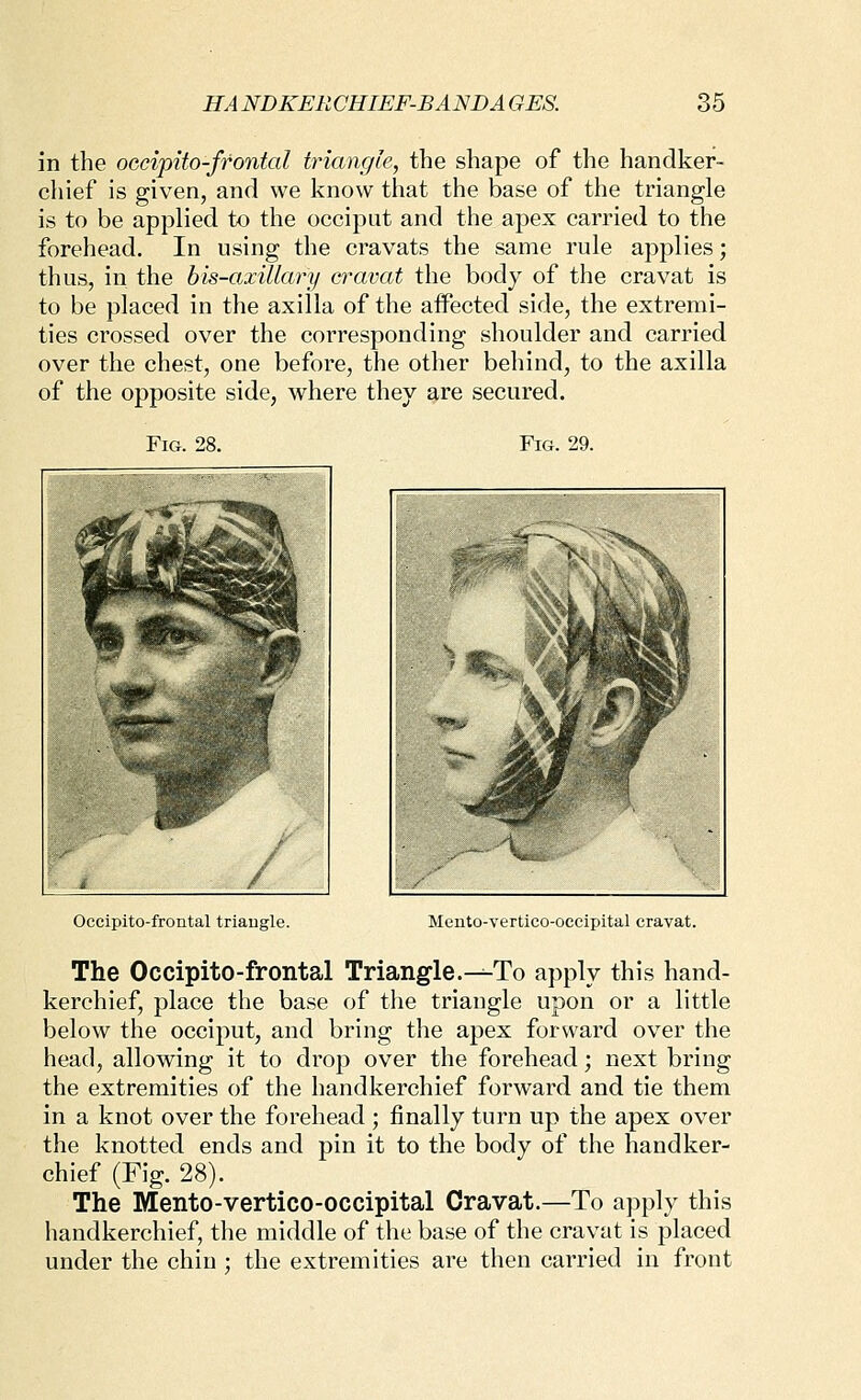 in the oecipito-ffontal triangle, the shape of the handker- chief is given, and we know that the base of the triangle is to be applied to the occiput and the apex carried to the forehead. In using the cravats the same rule applies; thus, in the bis-axillary cravat the body of the cravat is to be placed in the axilla of the affected side, the extremi- ties crossed over the corresponding shoulder and carried over the chest, one before, the other behind, to the axilla of the opposite side, where they are secured. Fig. 28. Fig. 29. Occipito-frontal triaugle. Mento-vertico-occipital cravat. The Occipito-frontal Triangle.-^To apply this hand- kerchief, place the base of the triangle upon or a little below the occiput, and bring tlie apex forward over the head, allowing it to drop over the forehead; next bring the extremities of the handkerchief forward and tie them in a knot over the forehead ; finally turn up the apex over the knotted ends and pin it to the body of the handker- chief (Fig. 28). The Mento-vertico-occipital Cravat.—To apply this handkerchief, the middle of the base of the cravat is placed under the chin : the extremities are then carried in front