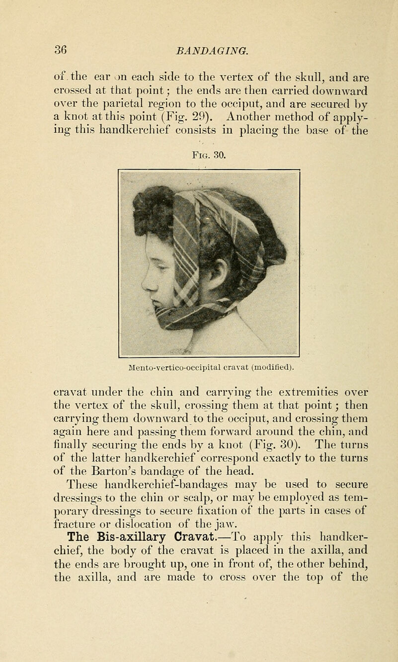 of. the ear on each side to the vertex of the skull, and are crossed at that point; the ends are then carried downward over the parietal region to the occiput, and are secured by a knot at this point (Fig. 29). Another method of apply- ing this handkerchief consists in placing the base of the Fig. 30. Mento-vertico-occipital cravat (modified). cravat under the chin and carrying the extremities over the vertex of the skull, crossing them at that point; then carrying them downward to the occiput, and crossing them again here and passing them forward around the chin, and finally securing the ends by a knot (Fig. 30). The turns of the latter handkerchief correspond exactly to the turns of the Barton's bandage of the head. These handkerchief-bandages may be used to secure dressings to the chin or scalp, or may be employed as tem- porary dressings to secure fixation of the parts in cases of fracture or dislocation of the jaw. The Bis-axillary Cravat.—To apply this handker- chief, the body of the cravat is placed in the axilla, and the ends are brought up, one in front of, the other behind, the axilla, and are made to cross over the top of the