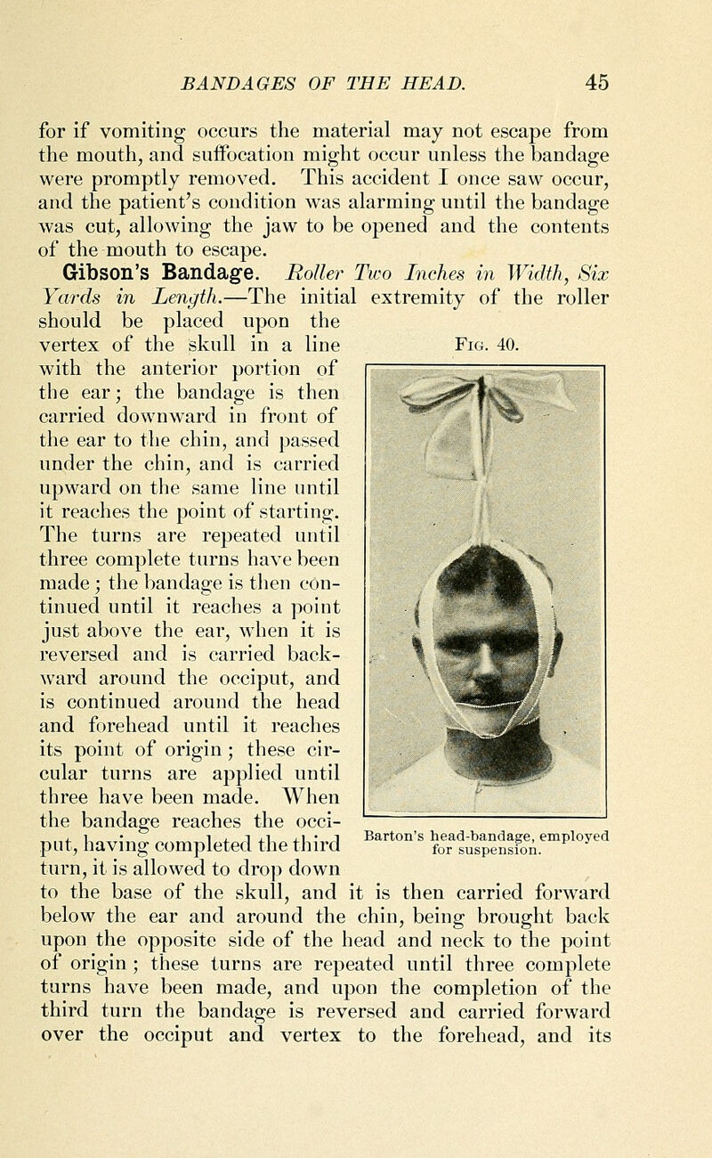 for if vomiting occurs the material may not escape from the mouth, and suffocation might occur unless the bandage were promptly removed. This accident I once saw occur, and the patient's condition was alarming until the bandage was cut, allowing the jaw to be opened and the contents of the mouth to escape. Gibson's Bandage. Roller Two Inches in Width, Six Yards in Length.—The initial extremity of the roller should be placed upon the vertex of the skull in a line with the anterior portion of the ear; the bandage is then carried downward in front of the ear to the chin, and passed under the chin, and is carried upward on the same line until it reaches the point of starting. The turns are repeated until three complete turns have been made ; the bandage is then con- tinued until it reaches a point just above the ear, when it is reversed and is carried back- ward around the occiput, and is continued around the head and forehead until it reaches its point of origin; these cir- cular turns are applied until three have been made. When the bandage reaches the occi- put, having completed the third turn, it is allowed to drop down to the base of the skull, and it is then carried forward below the ear and around the chin, being brought back upon the opposite side of the head and neck to the point of origin ; these turns are repeated until three complete turns have been made, and upon the completion of the third turn the bandage is reversed and carried forward over the occiput and vertex to the forehead, and its Fig. 40. N [/ ^^H^m i ^^^ ^ Barton's head-bandage, employed for suspension.