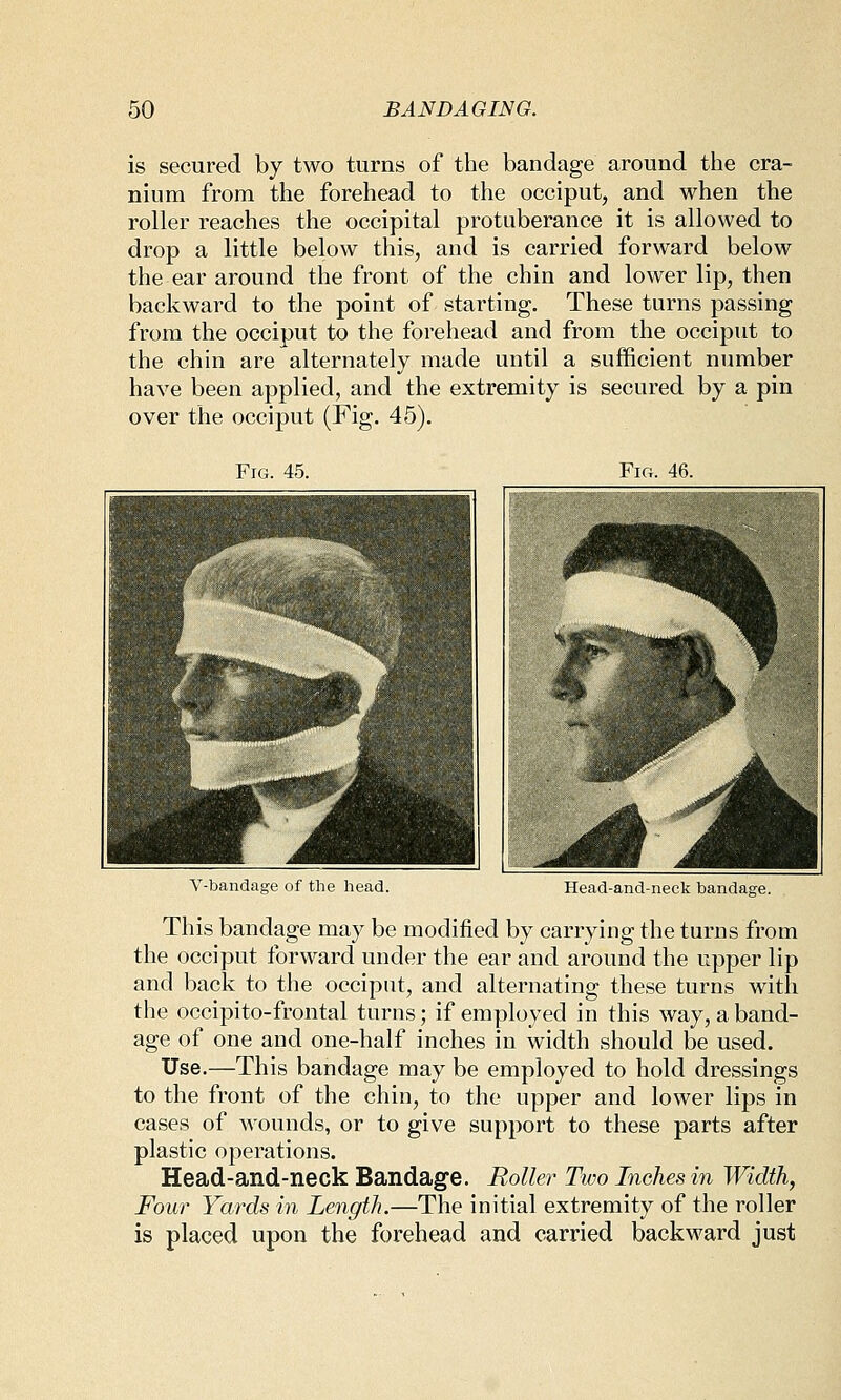 is secured by two turns of the bandage around the cra- nium from the forehead to the occiput, and when the roller reaches the occipital protuberance it is allowed to drop a little below this, and is carried forward below the ear around the front of the chin and lower lip, then backward to the point of starting. These turns passing from the occiput to the forehead and from the occiput to the chin are alternately made until a sufficient number have been applied, and the extremity is secured by a pin over the occiput (Fig. 45). Fig. 45. Fig. 4fi. This bandage may be modified by carrying the turns from the occiput forward under the ear and around the upper lip and back to the occiput, and alternating these turns with tlie occipito-frontal turns; if employed in this way, a band- age of one and one-half inches in width should be used. Use,—This bandage may be employed to hold dressings to the front of the chin, to the upper and lower lips in cases of wounds, or to give support to these parts after plastic operations. Head-and-neck Bandage. Roller Two Inches in Width, Four Yards in Length.—The initial extremity of the roller is placed upon the forehead and carried backward just