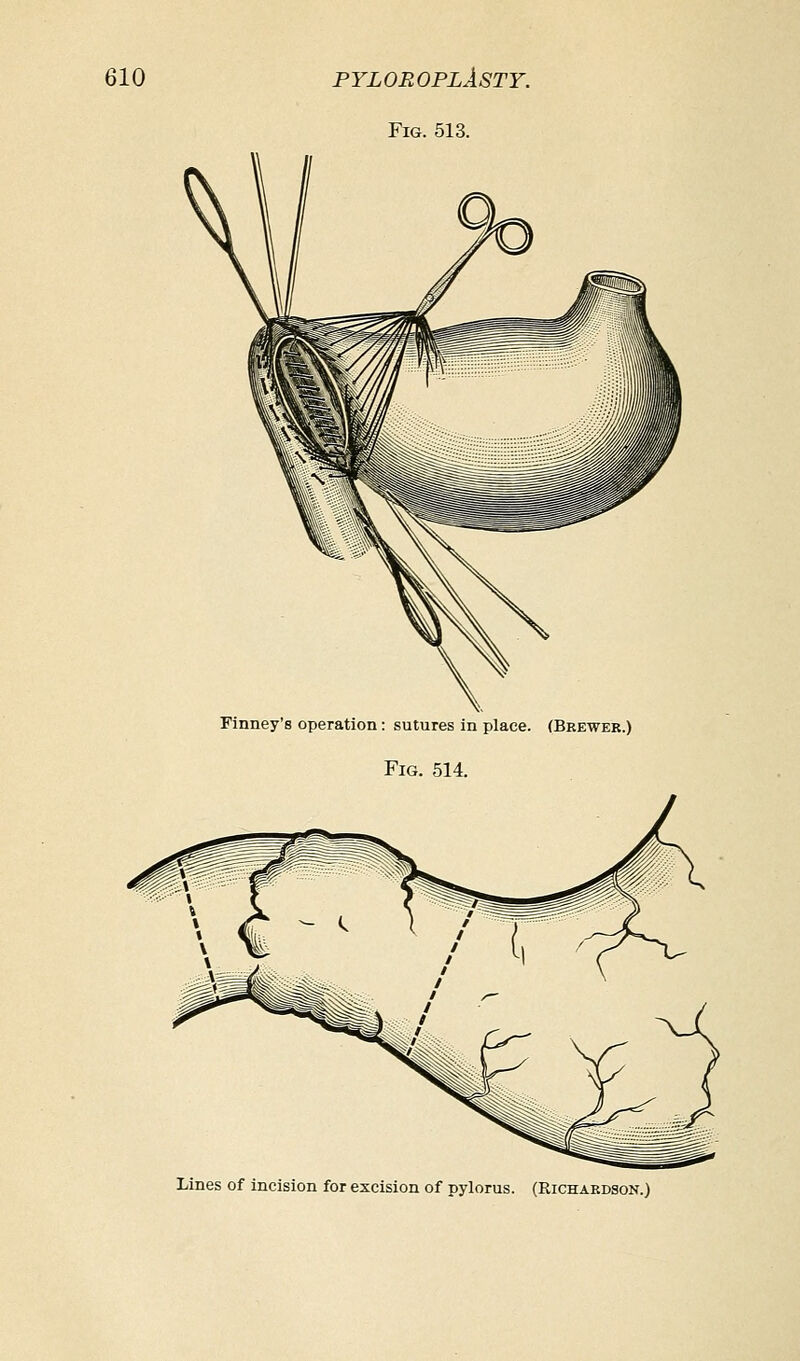 Fig. 513. Finney's operation: sutures in place. (Brewer.) Fig. 514. Lines of incision for excision of pylorus. (Richardson.)