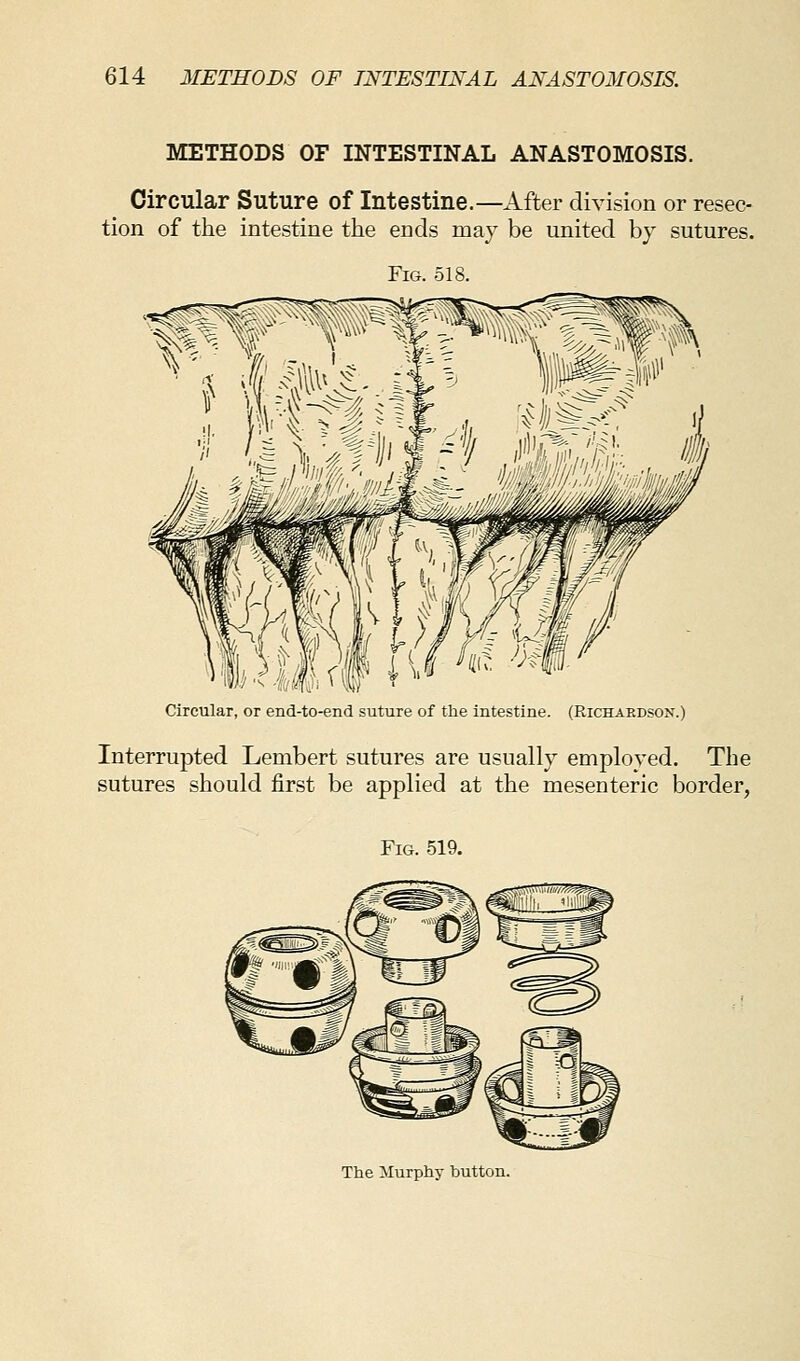 METHODS OF INTESTINAL ANASTOMOSIS. Circular Suture of Intestine.—After division or resec- tion of the intestine the ends may be united by sutures. Fig. 518. Circular, or end-to-end suture of the intestine. (Richardson.) Interrupted Lembert sutures are usually employed. The sutures should first be applied at the mesenteric border, Fig. 519. The Murphy button.