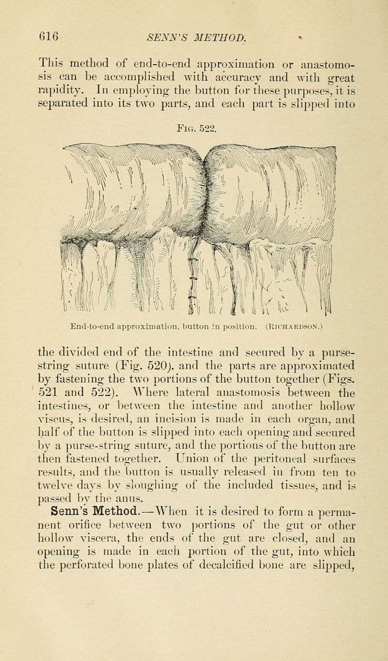 This method of end-to-enci approximation or anastomo- sis can be accomplished with accuracy and with great rapidity. In employing the button for these purposes, it is separated into its two parts, and each part is slipjied into Fig. 522. ;.4Tt\';|,«--tfli a^ '1) /' '^'^ E (:!%i\(u \ End-to-end approximation, button in position. (Richardson.) the divided end of the intestine and secured by a purse- string suture (Fig. 520j. and the parts are approximated by fastening the two portions of the button together (Figs. 521 and 522). Where lateral anastomosis between the intestines, or between the intestine and another hollow viscus, is desired, an incision is made in each organ, and half of the button is slipped into each opening and secured by a purse-string suture, and the portions of the button are then fastened together. Union of the peritoneal surfaces results, and the button is usually released in from ten to twelve days by sloughing of the included tissues, and is passed by the anus. Senn's Method.—AVhen it is desired to form a perma- nent orifice between two portions of the gut or other hollow viscera, the ends of the gut are closed, and an opening is made in each portion of the gut, into which the perforated bone plates of decalcified bone are slipped,