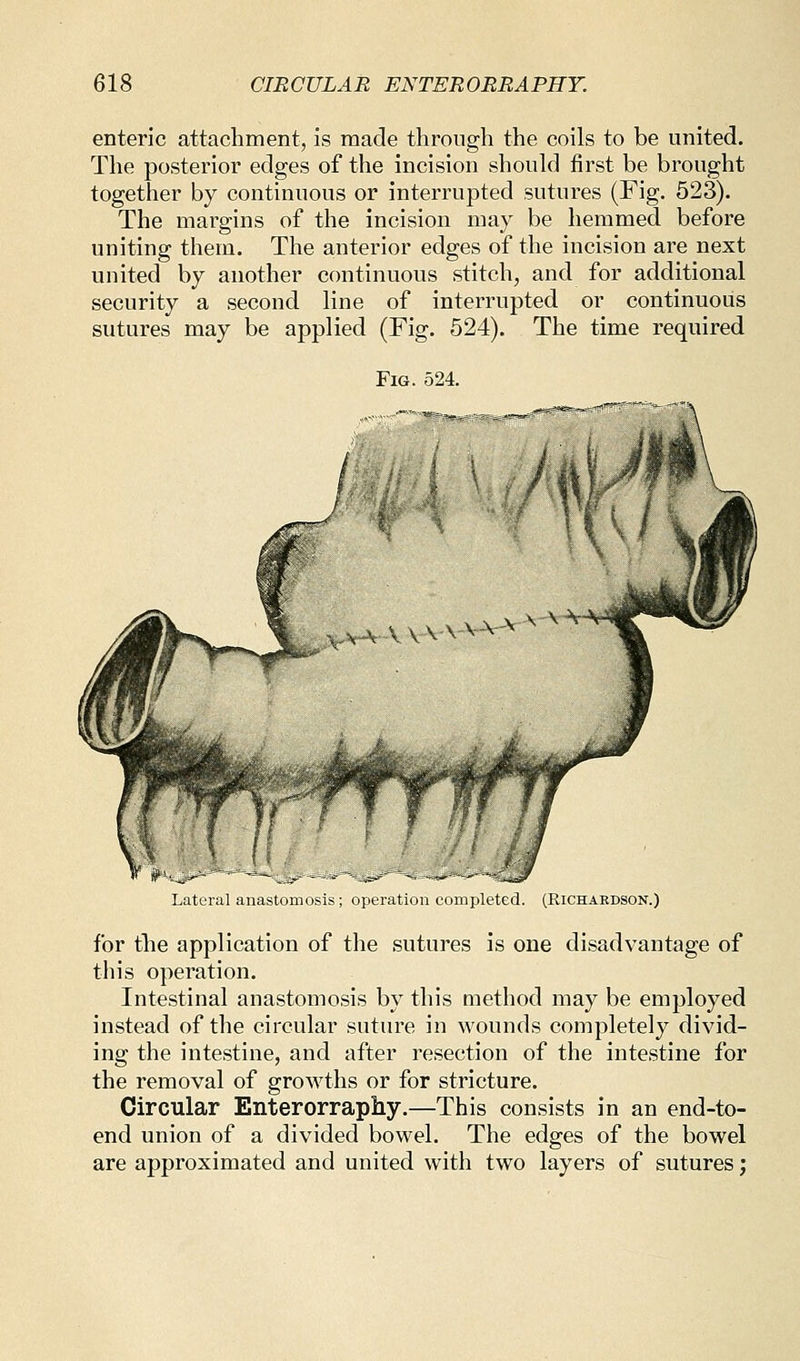 enteric attachment, is made through the coils to be united. The posterior edges of the incision should first be brought together by continuous or interrupted sutures (Fig. 523). The margins of the incision may be hemmed before uniting them. The anterior edges of the incision are next united by another continuous stitch, and for additional security a second line of interrupted or continuous sutures may be applied (Fig. 524). The time required Fig. 524. Lateral anastomosis; operation completed. (Richardson.) for the application of the sutures is one disadvantage of this operation. Intestinal anastomosis by this method may be employed instead of the circular suture in wounds completely divid- ing the intestine, and after resection of the intestine for the removal of growths or for stricture. Circular Enterorrapliy.—This consists in an end-to- end union of a divided bowel. The edges of the bowel are approximated and united with two layers of sutures;