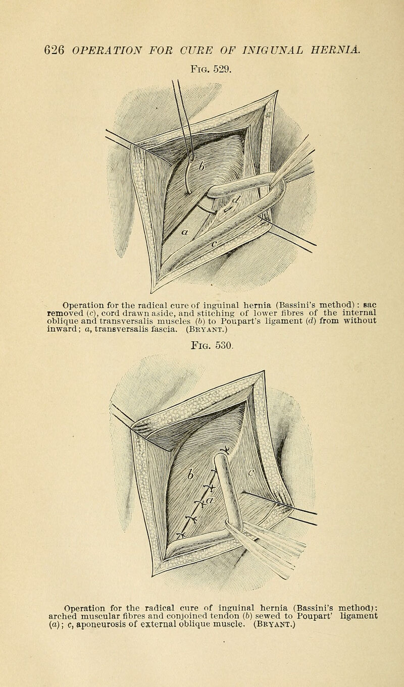 Fig. 529. Operation for the radical cure of inguinal hernia (Bassini's method): sac removed (c), cord drawn aside, and stitching of lower fibres of the internal oblique and transversalis muscles (6) to Poupart's ligament (d) from without inward; o, transversalis fascia. (Bryant.) Fig. 530. Operation for the radical cure of inguinal hernia (Bassini's method): arched muscular fibres and conjoined tendon (b) sewed to Poupart' ligament (a); c, aponeurosis of external oblique muscle. (Beyant.)