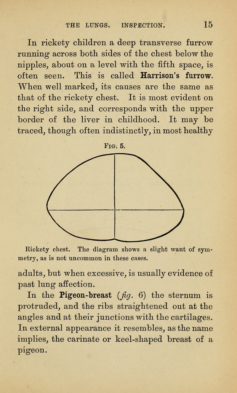 In rickety cliildren a deep transverse furrow running across botli sides of tlie cliest below the nipples^ about on a level with the fifth space^ is often seen. This is called Harrison's furrow. When well niarked_, its causes are the same as that of the rickety chest. It is most evident on the right side, and corresponds with the upper border of the liver in childhood. It may be traced, though often indistinctly, in most healthy Fm. 5. Rickety chest. The diagram shows a slight want of sym- metry, as is not uncommon in these cases. adults, but when excessive, is usually evidence of past lung affection. In the Pigeon-breast {fig. 6) the sternum is protruded, and the ribs straightened out at the angles and at their junctions with the cartilages. In external appearance it resembles, as the name implies, the carinate or keel-shaped breast of a pigeon.
