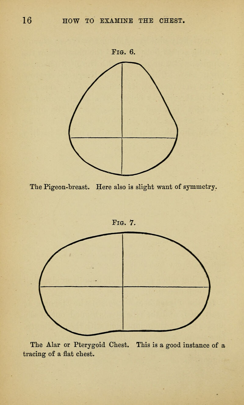 ri&. 6. The Pigeon-breast. Here also is slight want of symmetry. ri&. 7. The Alar or Pterygoid Chest. This is a good instance of a tracing of a flat chest.