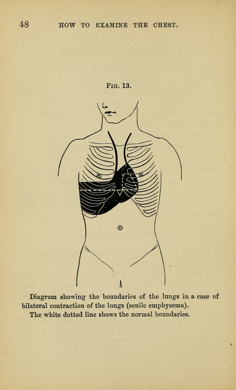 Diagram showing the boundaries of the lungs in a case of bilateral contraction of the lungs (senile emphysema). The white dotted line shows the normal boundaries.