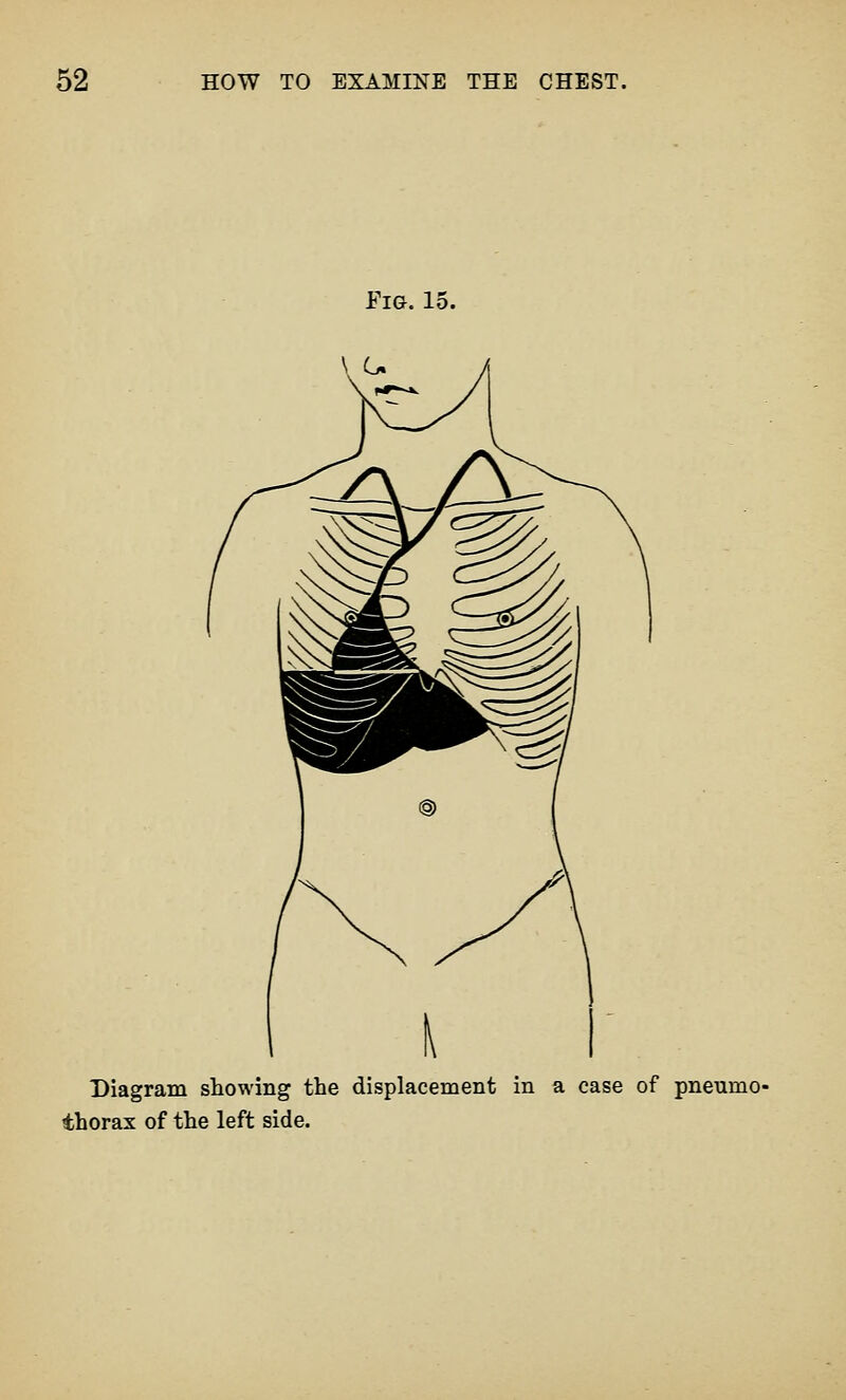 Fig. 15. Diagram showing the displacement in a case of pneumo- thorax of the left side.