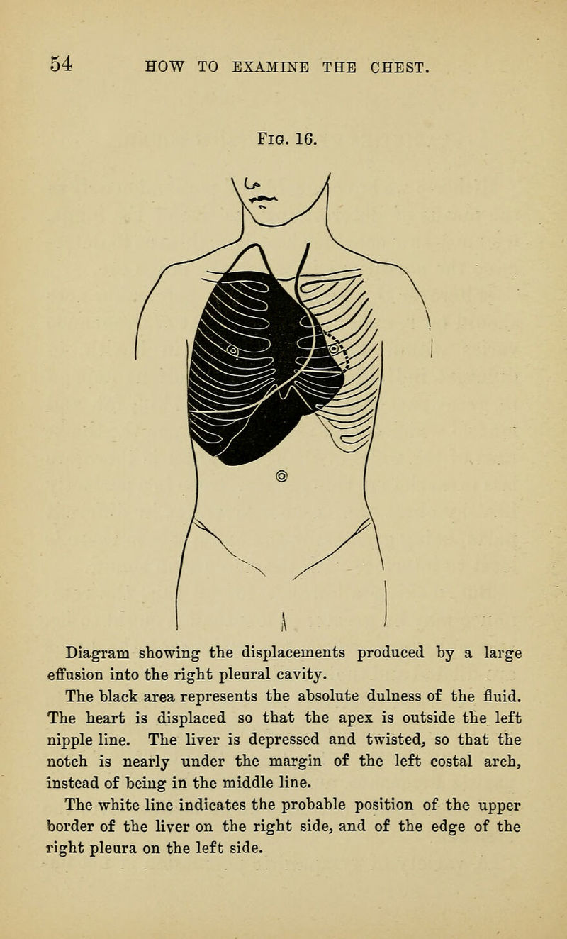 Fig. 16. Diagram showing the displacements produced by a large effusion into the right pleural cavity. The black area represents the absolute dulness of the fluid. The heart is displaced so that the apex is outside the left nipple line. The liver is depressed and twisted, so that the notch is nearly under the margin of the left costal arch, instead of being in the middle line. The white line indicates the probable position of the upper border of the liver on the right side, and of the edge of the I'ight pleura on the left side.