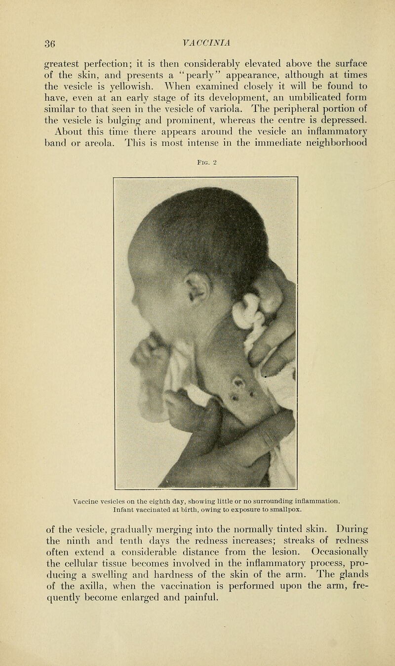 greatest perfection; it is then considerably elevated above the surface of the skin, and presents a pearly appearance, although at times the vesicle is yellowish. When examined closely it will be found to have, even at an early stage of its development, an umbilicated form similar to that seen in the vesicle of variola. The peripheral portion of the vesicle is bulging and prominent, whereas the centre is depressed. About this time there appears around the vesicle an inflammatory band or areola. This is most intense in the immediate neighborhood Fig. 2 Vaccine vesicles on the eigtith day, showing little or no surrounding inflammation. Infant vaccinated at birth, owing to exposure to smallpox. of the vesicle, gradually merging into the normally tinted skin. During the ninth and tenth days the redness increases; streaks of redness often extend a considerable distance from the lesion. Occasionally the cellular tissue becomes involved in the inflammatory process, pro- ducing a swelling and hardness of the skin of the arm. The glands of the axilla, when the vaccination is performed upon the arm, fre- quently become enlarged and painful.