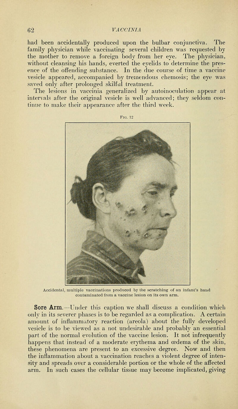 had been accidentally produced upon the bulbar conjunctiva. The family physician while vaccinating several children was requested by the mother to remove a foreign body from her eye. The physician, without cleansing his hands, everted the eyelids to determine the pres- ence of the offending substance. In the due course of time a vaccine vesicle appeared, accompanied by tremendous chemosis; the eye was saved only after prolonged skilful treatment. The lesions in vaccinia generalized by autoinoculation appear at intervals after the original vesicle is well advanced; they seldom con- tinue to make their appearance after the third week. Fig. 12 Accidental, multiple vaccinations produced by the scratching of an infant's hand contaminated from a vaccine lesion on its own arm. Sore Arm.—Under this caption we shall discuss a condition which only in its severer phases is to be regarded as a complication. A certain amount of inflammatory reaction (areola) about the fully developed vesicle is to be viewed as a not undesirable and probably an essential part of the normal evolution of the vaccine lesion. It not infrequently happens that instead of a moderate erythema and oedema of the skin, these phenomena are present to an excessive degree. Now and then the inflammation about a vaccination reaches a violent degree of inten- sity and spreads over a considerable portion or the whole of the affected arm. In such cases the cellular tissue may become implicated, giving