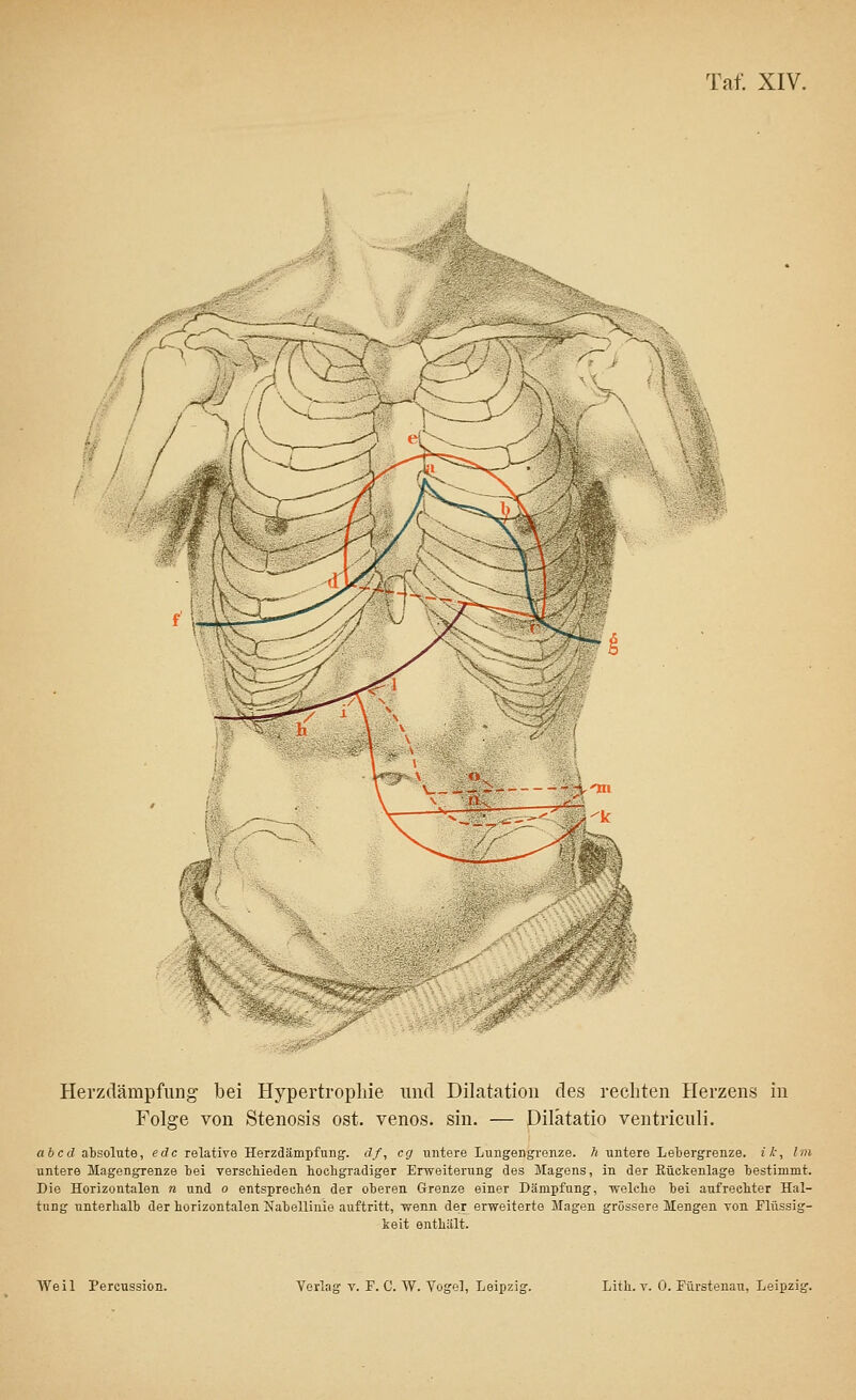 Herzdämpfung bei Hypertrophie und Dilatation des rechten Herzens in Folge von Stenosis ost. venös, sin. — Dilätatio ventricnli. abcd absolute, edc relative Herzdämpfung, df, cg untere Lungengrenze, h untere Lebergrenze, ik, Im untere Magengrenze bei verschieden hochgradiger Erweiterung des Magens, in der Rückenlage bestimmt. Die Horizontalen n und o entsprechen der oberen Grenze einer Dämpfung, welche bei aufrechter Hal- tung unterhalb der horizontalen Kabellinie auftritt, wenn der erweiterte Magen grössere Mengen von Flüssig- keit enthält.