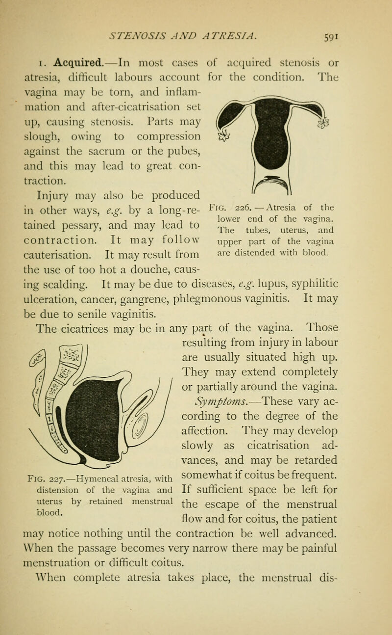 of acquired stenosis or for the condition. The Fig. 226.—Atresia of the lower end of the vagina. The tubes, uterus, and vipper part of the vagina are distended with blood. I. Acquired.—In most cases atresia, difficult labours account vagina may be torn, and inflam- mation and after-cicatrisation set up, causing stenosis. Parts may slough, owing to compression against the sacrum or the pubes, and this may lead to great con- traction. Injury may also be produced in other ways, e.g. by a long-re- tained pessary, and may lead to contraction. It may follow cauterisation. It may result from the use of too hot a douche, caus- ing scalding. It may be due to diseases, e.g. lupus, syphilitic ulceration, cancer, gangrene, phlegmonous vaginitis. It may be due to senile vaginitis. The cicatrices may be in any part of the vagina. Those resulting from injury in labour are usually situated high up. They may extend completely or partially around the vagina. Symptoms.-—These vary ac- cording to the degree of the affection. They may develop slowly as cicatrisation ad- vances, and may be retarded Fig. 227.-Hymeneal atresia, with somewhat if coitus be frequent. distension of the vagina and If Sufficient space be left for by retained menstrual ^^e escape of the menstrual flow^ and for coitus, the patient may notice nothing until the contraction be w^ell advanced. When the passage becomes very narrow there may be painful menstruation or difficult coitus. When complete atresia takes place, the menstrual dis- uterus blood.