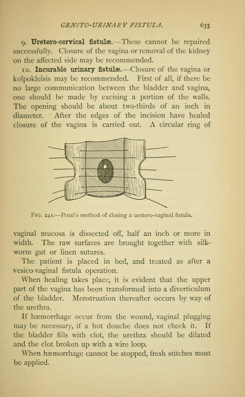 9. Uretero-cervical fistulse.—These cannot be repaired successfully. Closure of the vagina or removal of the kidney on the affected side may be recommended. 10. Incurable urinary fistulae.—Closure of the vagina or kolpokleisis may be recommended. First of all, if there be no large communication between the bladder and vagina, one should be made by excising a portion of the walls. The opening should be about two-thirds of an inch in diameter. After the edges of the incision have healed closure of the vagina is carried out. A circular ring of Fig. 241.-—Pozzi's method of closing a uretero-vaginal fistula. vaginal mucosa is dissected off, half an inch or more in width. The raw surfaces are brought together with silk- worm gut or linen sutures. The patient is placed in bed, and treated as after a vesico-vaginal fistula operation. When healing takes place, it is evident that the upper part of the vagina has been transformed into a diverticulum of the bladder. Menstruation thereafter occurs by way of the urethra. If haemorrhage occur from the wound, vaginal plugging may be necessary, if a hot douche does not check it. If the bladder fills with clot, the urethra should be dilated and the clot broken up with a wire loop. When hEemorrhage cannot be stopped, fresh stitches must be applied.