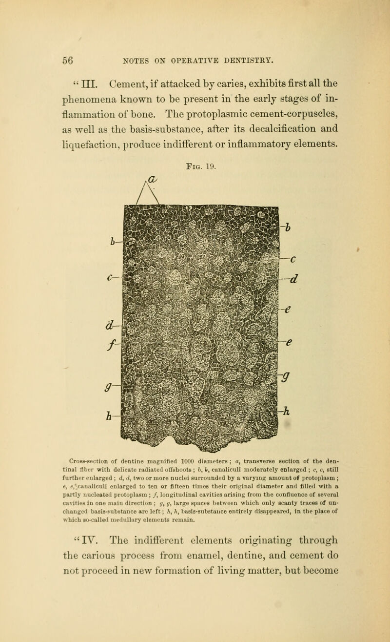  ni. Cement, if attacked by caries, exhibits first all the phenomena known to be present in the early stages of in- flammation of bone. The protoplasmic cement-corpuscles, as well as the basis-substance, after its decalcification and liquefaction, produce indifferent or inflammatory elements. Fig. 19. Cross-section of dentine magnified 1000 diameters ; a, transTerse section of the den- tinal fiber with delicate radiated ofi'shootB ; l, l>, canaliculi moderately enlarged ; c, c, still further enlarged ; d, <l, two or more nuclei surrounded by a varying amount ol iirotoplasm ; e, e,'.canaliculi enlarged to ten or fifteen times their original diameter and filled with a partly nucleated protoplasm ; /, longitudinal cavities arising from the confluence of several cavities in one main direction ; y, g, large spaces Ijetween which only scanty traces of un- changed basis-Fubstance are left; h, h, basis-substance entirely disappeared, in the place of which so-called medullary elements remain. IV. The indifferent elements originating through the carious process from enamel, dentine, and cement do not proceed in new formation of living matter, but become