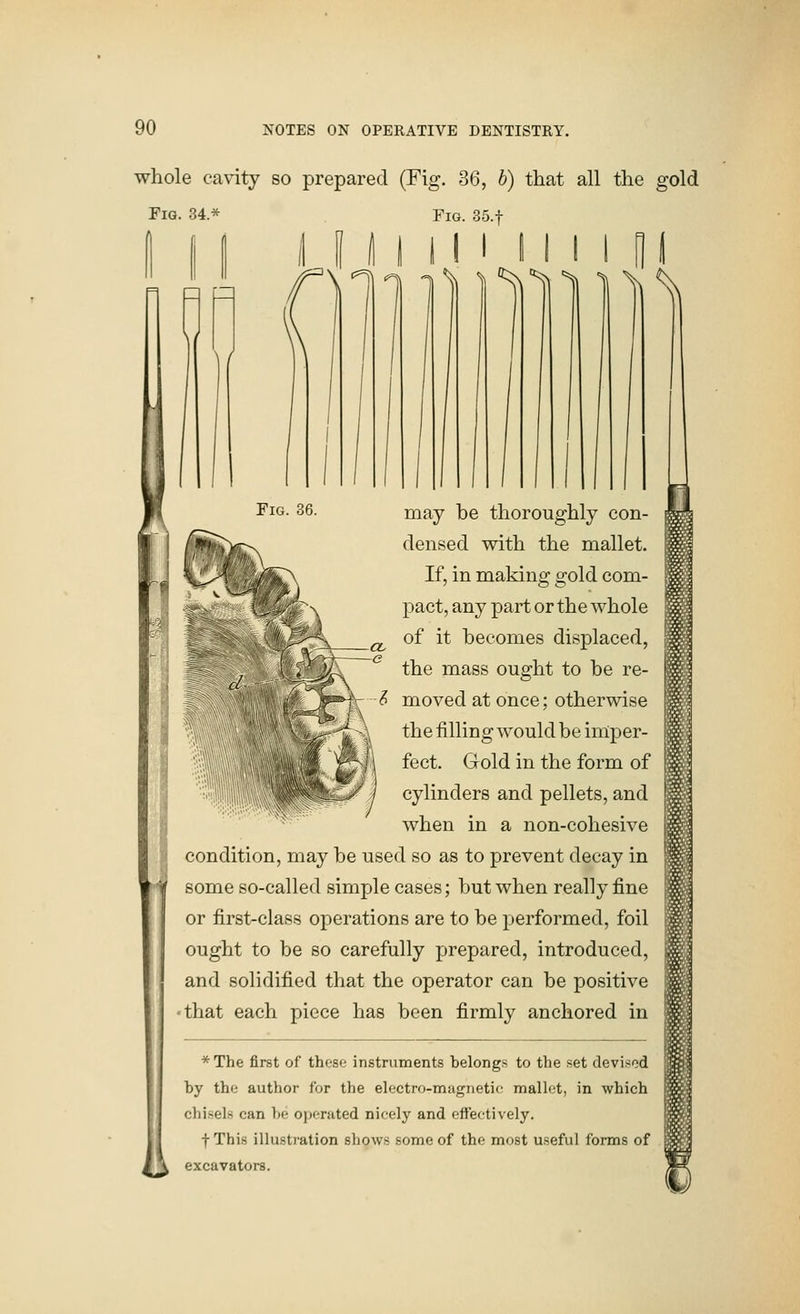 whole cavity so prepared (Fig. 36, 6) that all the gold Fig. 34* Fig. SS.f >'* li ■^ '^ 11 may be thoroughly con- densed with the mallet. If, in making gold com- pact, any part or the whole of it becomes displaced, the mass ought to be re- moved at once; otherwise the filling would be imper- fect. Gold in the form of cylinders and pellets, and when in a non-cohesive condition, may be used so as to prevent decay in some so-called simple cases; but when really fine or first-class operations are to be performed, foil ought to be so carefully prepared, introduced, and solidified that the operator can be positive ■ that each piece has been firmly anchored in * The first of these instruments belongs to the set devised by the author for the electro-magnetic mallet, in which chisels can be operated nicely and effectively. f This illustration shows some of the most useful forms of excavators.