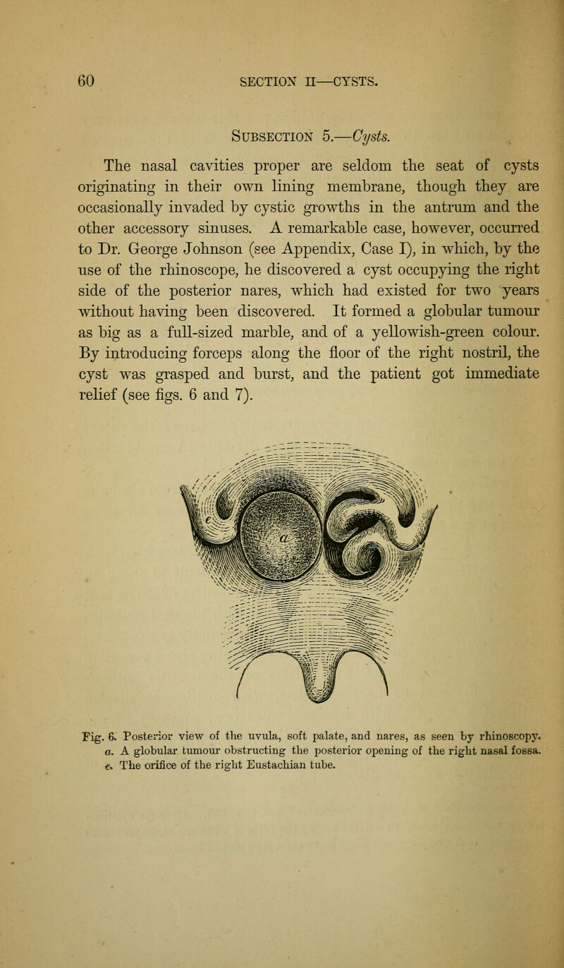 Subsection 5.—Cysts. The nasal cavities proper are seldom the seat of cysts originating in their own lining membrane, though they are occasionally invaded by cystic gTowths in the antrum and the other accessory sinuses. A remarkable case, however, occurred to Dr. George Johnson (see Appendix, Case I), in which, by the use of the rhinoscope, he discovered a cyst occupying the right side of the posterior nares, which had existed for two years without having been discovered. It formed a globular tumour as big as a full-sized marble, and of a yellowish-green colour. By introducing forceps along the floor of the right nostril, the cyst was grasped and burst, and the patient got immediate relief (see figs. 6 and 7). Fig. 6. Posterior view of the uvula, soft palate, and nares, as seen by rhinoscopy^ a. A globular tumour obstructing the posterior opening of the right nasal fossa. c. The orifice of the right Eustachian tube.
