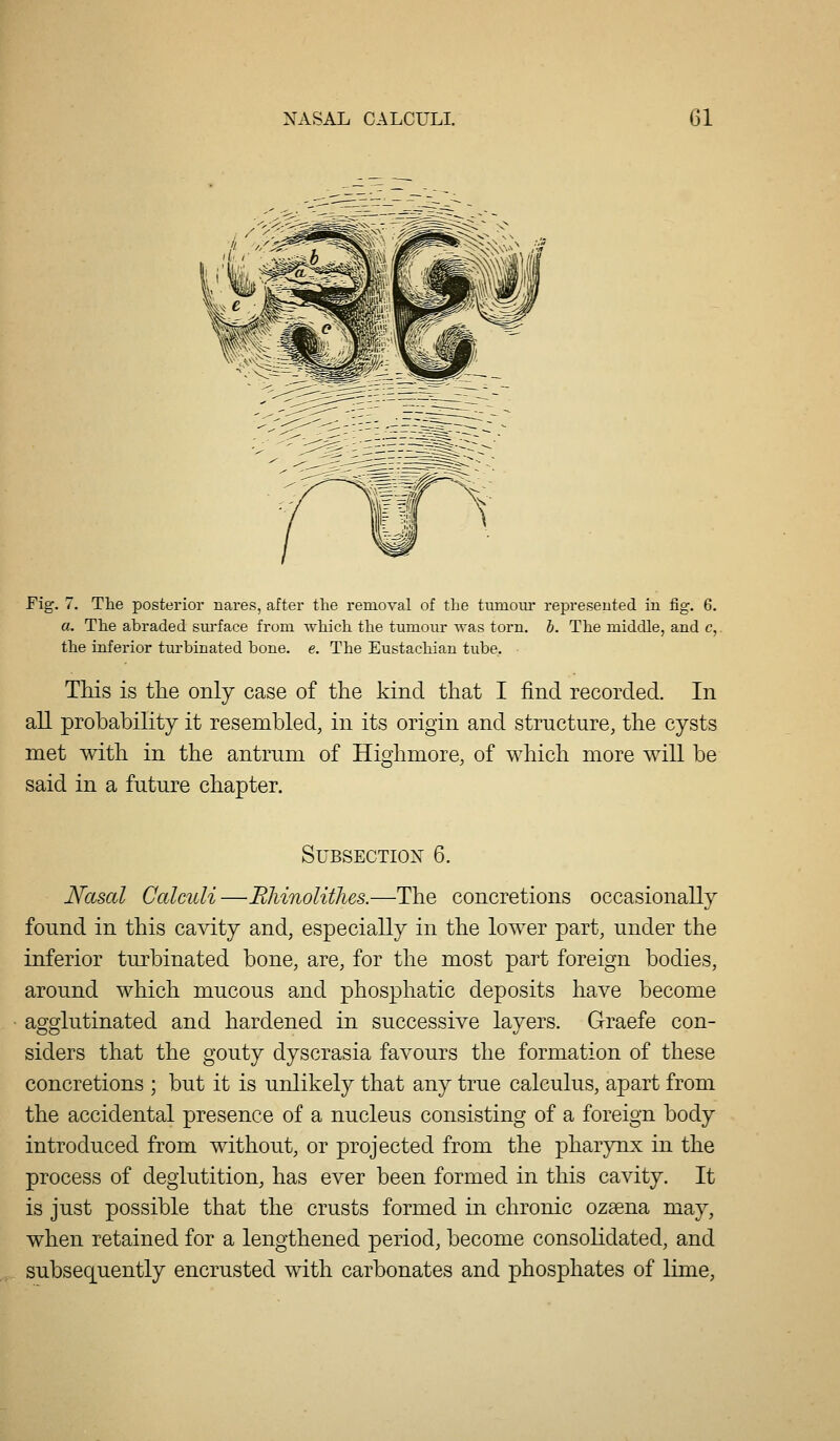 Fig. 7. The posterior nares, after the removal of the tumour represented in fig. 6. a. The abraded sm-face from which the tumour was torn. h. The middle, and c, the inferior turbinated bone. e. The Eustachian tube. This is the only case of the kind that I find recorded. In all probability it resembled, in its origin and structure, the cysts met with in the antrum of Highmore, of which more will be said in a future chapter. Subsection 6. Nasal Calculi—Rliinolithes.—The concretions occasionally found in this cavity and, especially in the lower part, under the inferior turbinated bone, are, for the most part foreign bodies, around which mucous and phosphatic deposits have become agglutinated and hardened in successive layers. Graefe con- siders that the gouty dyscrasia favours the formation of these concretions ; but it is unlikely that any true calculus, apart from the accidental presence of a nucleus consisting of a foreign body introduced from without, or projected from the pharynx in the process of deglutition, has ever been formed in this cavity. It is just possible that the crusts formed in chronic ozsena may, when retained for a lengthened period, become consolidated, and subsequently encrusted with carbonates and phosphates of lime,
