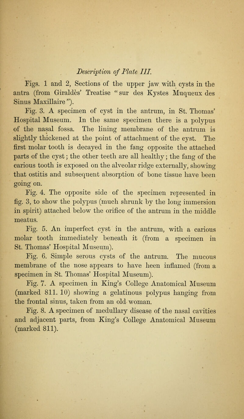 Description of Plate III. Figs. 1 and 2, Sections of the upper jaw with cysts in tlie antra (from Giraldes' Treatise  snr des Kystes Muqueux des Sinus Maxillaire ). Fig. 3. A specimen of cyst in the antrum, in St. Thomas' Hospital Mnseum. In the same specimen there is a polypus of the nasal fossa. The lining membrane of the antrum is slightly thickened at the point of attachment of the cyst. The first molar tooth is decayed in the fang opposite the attached parts of the cyst; the other teeth are all healthy; the fang of the carious tooth is exposed on the alveolar ridge externally, showing that ostitis and subsequent absorption of bone tissue have been going on. Fig. 4. The opposite side of the specimen represented in fig. 3, to show the polypus (much shrunk by the long immersion in spirit) attached below the orifice of the antrum in the middle meatus. Fig. 5. An imperfect cyst in the antrum, with a carious molar tooth immediately beneath it (from a specimen in St. Thomas' Hospital Museum). Fig. 6. Simple serous cysts of the antrum. The mucous membrane of the nose appears to have heen inflamed (from a specimen in St. Thomas' Hospital Museum). Fig. 7. A specimen in King's College Anatomical Museum (marked 811. 10) showing a gelatinous polypus hanging from the frontal sinus, taken from an old-woman. Fig. 8. A specimen of meduUary disease of the nasal cavities and adjacent parts, from King's College Anatomical Museum (marked 811).