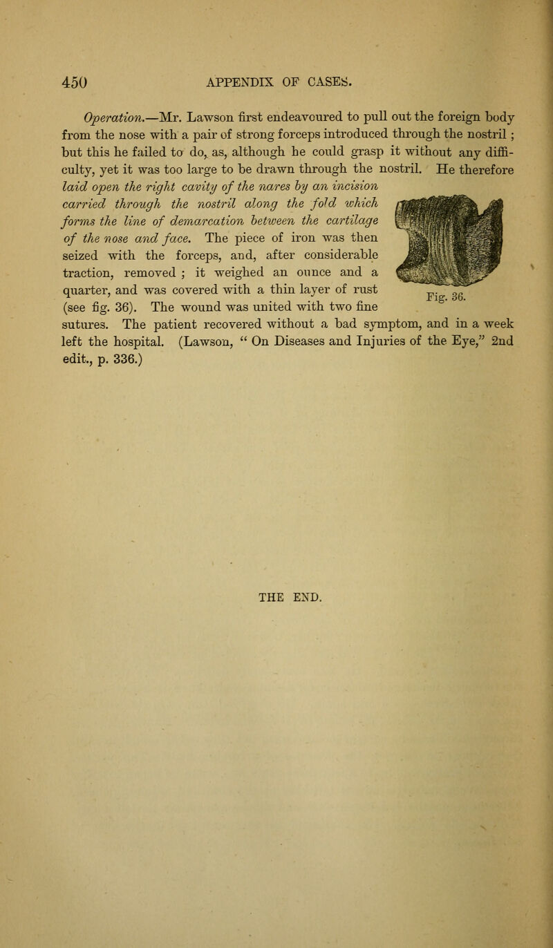 Operation.—Mr. Lawson first endeavoured to pull out the foreign body from the nose with a pair of strong forceps introduced through the nostril; but this he failed to do^ as, although he could grasp it without any diffi- culty, yet it was too large to be drawn through the nostril. He therefore laid open the right cavity of the nares hy an incision carried through the nostril along the fold which forms the line of demarcation between the cartilage of the nose and face. The piece of iron was then seized with the forceps, and, after considerable traction, removed ; it weighed an ounce and a quarter, and was covered with a thin layer of rust (see fig. 36). The wound was united with two fine sutures. The patient recovered without a bad symptom, and in a week left the hospital. (Lawson,  On Diseases and Injuries of the Eye, 2nd edit., p. 336.) Fig. 36. THE END.