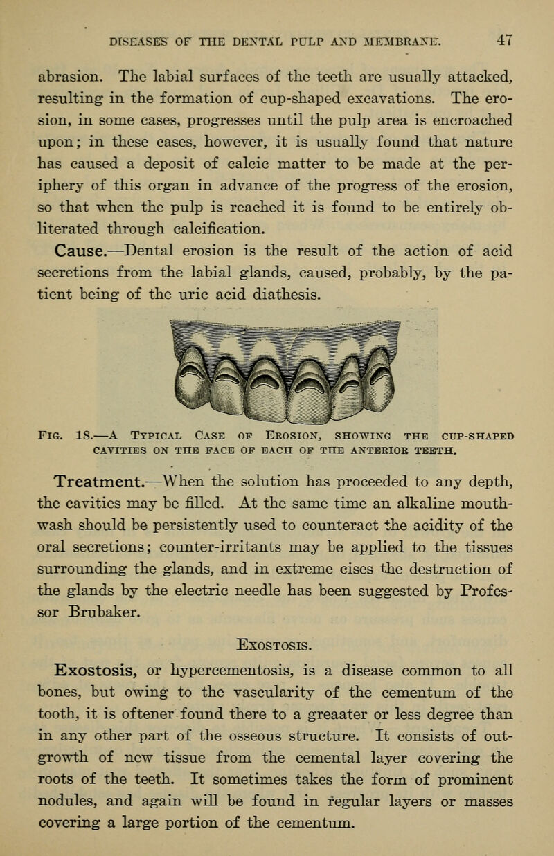 abrasion. The labial surfaces of the teeth are usually attacked, resulting in the formation of cup-shaped excavations. The ero- sion, in some cases, progresses until the pulp area is encroached upon; in these cases, however, it is usually found that nature has caused a deposit of calcic matter to be made at the per- iphery of this organ in advance of the progress of the erosion, so that when the pulp is reached it is found to be entirely ob- literated through calcification. Cause.—Dental erosion is the result of the action of acid secretions from the labial glands, caused, probably, by the pa- tient being of the uric acid diathesis. Fig. 18.—A TypiCAii Case of Erosion, showing the cup-shaped CAVITIES on the FACE OF EACH OF THE ANTERIOE TEETH. Treatment.—^When the solution has proceeded to any depth, the cavities may be filled. At the same time an alkaline mouth- wash should be persistently used to counteract the acidity of the oral secretions; counter-irritants may be applied to the tissues surrounding the glands, and in extreme cises the destruction of the glands by the electric needle has been suggested by Profes- sor Brubaker. Exostosis. Exostosis, or hypercementosis, is a disease common to all bones, but owing to the vascularity of the cementum of the tooth, it is oftener found there to a greaater or less degree than in any other part of the osseous structure. It consists of out- growth of new tissue from the cemental layer covering the roots of the teeth. It sometimes takes the form of prominent nodules, and again will be found in regular layers or masses covering a large portion of the cementum.