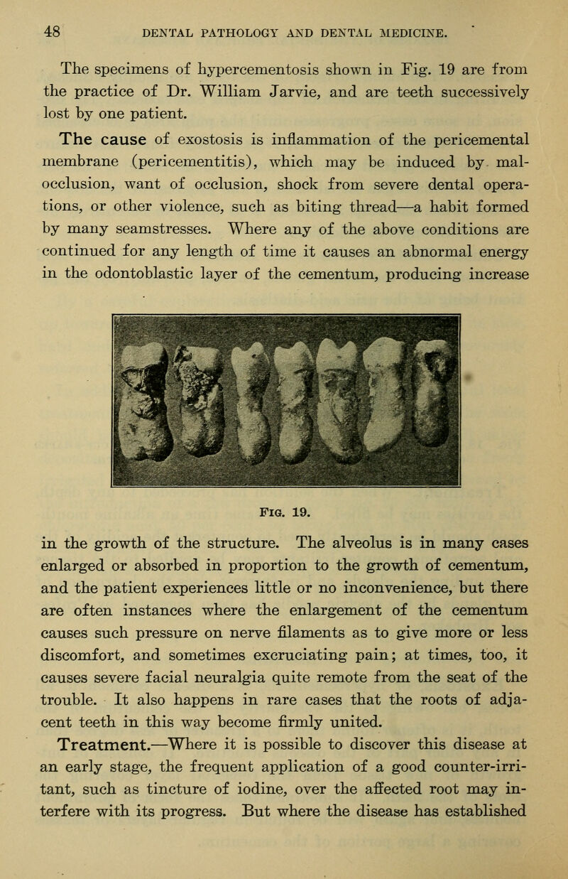 The specimens of hypercementosis shown in Fig. 19 are from the practice of Dr. William Jarvie, and are teeth successively lost by one patient. The cause of exostosis is inflammation of the pericemental membrane (pericementitis), which may be induced by mal- occlusion, want of occlusion, shock from severe dental opera- tions, or other violence, such as biting thread—a habit formed by many seamstresses. Where any of the above conditions are continued for any length of time it causes an abnormal energy in the odontoblastic layer of the cementum, producing increase Fig. 19. in the growth of the structure. The alveolus is in many cases enlarged or absorbed in proportion to the growth of cementum, and the patient experiences little or no inconvenience, but there are often instances where the enlargement of the cementum causes such pressure on nerve filaments as to give more or less discomfort, and sometimes excruciating pain; at times, too, it causes severe facial neuralgia quite remote from the seat of the trouble. It also happens in rare cases that the roots of adja- cent teeth in this way become firmly united. Treatment.—^Where it is possible to discover this disease at an early stage, the frequent application of a good counter-irri- tant, such as tincture of iodine, over the affected root may in- terfere with its progress. But where the disease has established