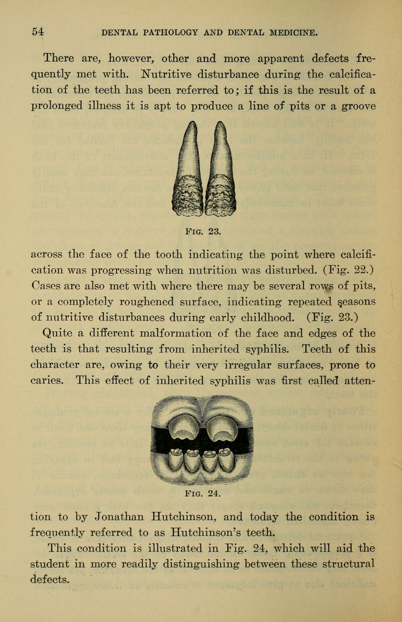 There are, however, other and more apparent defects fre- quently met with. Nutritive disturbance during the calcifica- tion of the teeth has been referred to; if this is the result of a prolonged illness it is apt to produce a line of pits or a groove Fig. 23. across the face of the tooth indicating the point where calcifi- cation was progressing when nutrition was disturbed. (Fig. 22.) Cases are also met with where there may be several rows of pits, or a completely roughened surface, indicating repeated Reasons of nutritive disturbances during early childhood. (Fig. 23.) Quite a different malformation of the face and edges of the teeth is that resulting from inherited syphilis. Teeth of this character are, owing to their very irregular surfaces, prone to caries. This effect of inherited syphilis was first called atten- FlG. 24. tion to by Jonathan Hutchinson, and today the condition is frequently referred to as Hutchinson's teeth. This condition is illustrated in Fig. 24, which will aid the student in more readily distinguishing between these structural defects.