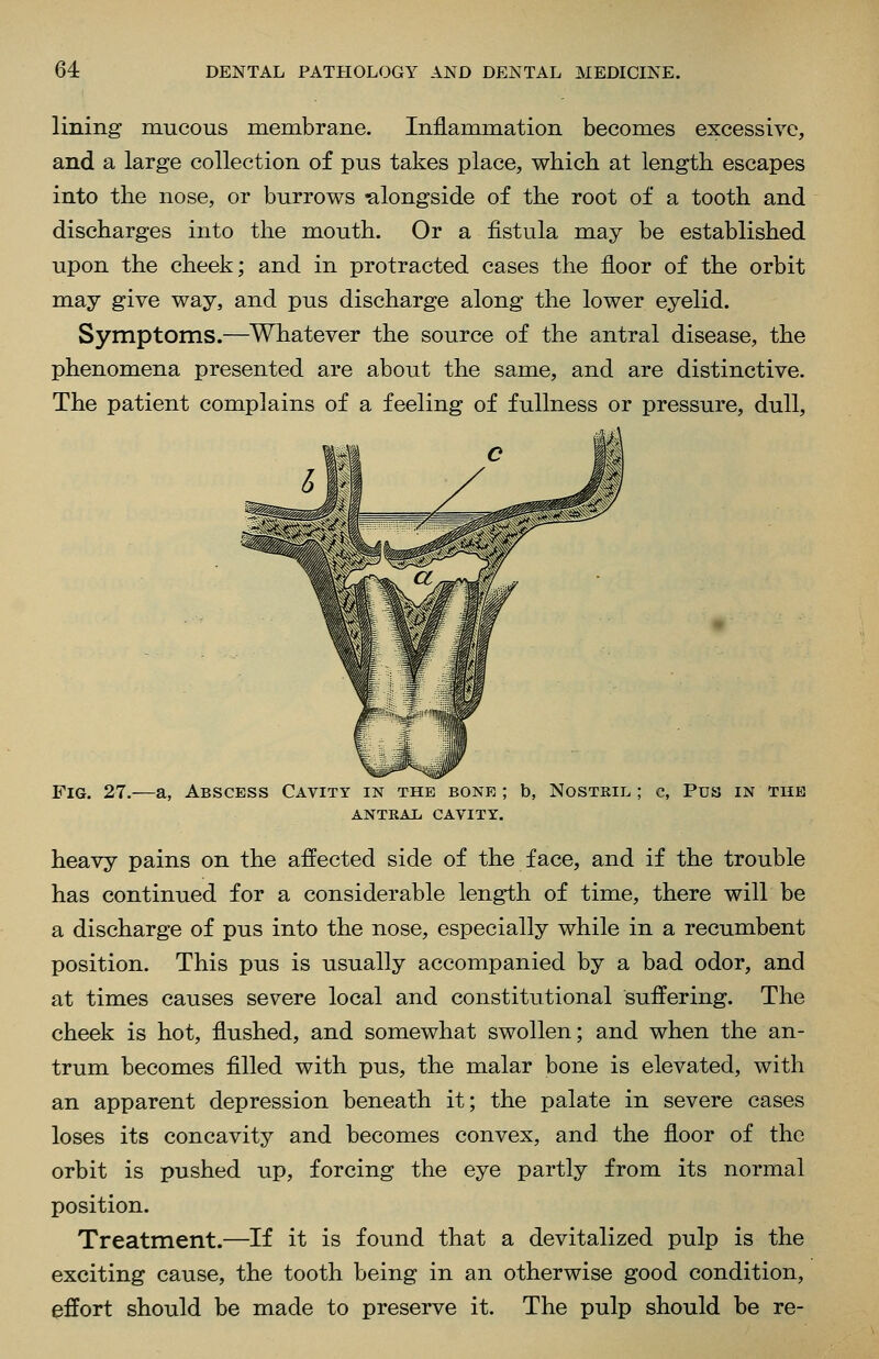 lining mucous membrane. Inflammation becomes excessive, and a large collection of pus takes place, which at length escapes into the nose, or burrows -alongside of the root of a tooth and discharges into the mouth. Or a fistula may be established upon the cheek; and in protracted cases the floor of the orbit may give way, and pus discharge along the lower eyelid. Symptoms.—Whatever the source of the antral disease, the phenomena presented are about the same, and are distinctive. The patient complains of a feeling of fullness or pressure, dull. Fig. 27.—a, Abscess Cavity in the bone ; b, Nostrum ; c, Pus in the ANTRAl, CAVITY. heavy pains on the affected side of the face, and if the trouble has continued for a considerable length of time, there will be a discharge of pus into the nose, especially while in a recumbent position. This pus is usually accompanied by a bad odor, and at times causes severe local and constitutional suffering. The cheek is hot, flushed, and somewhat swollen; and when the an- trum becomes filled with pus, the malar bone is elevated, with an apparent depression beneath it; the palate in severe cases loses its concavity and becomes convex, and the floor of the orbit is pushed up, forcing the eye partly from its normal position. Treatment.—If it is found that a devitalized pulp is the exciting cause, the tooth being in an otherwise good condition, effort should be made to preserve it. The pulp should be re-