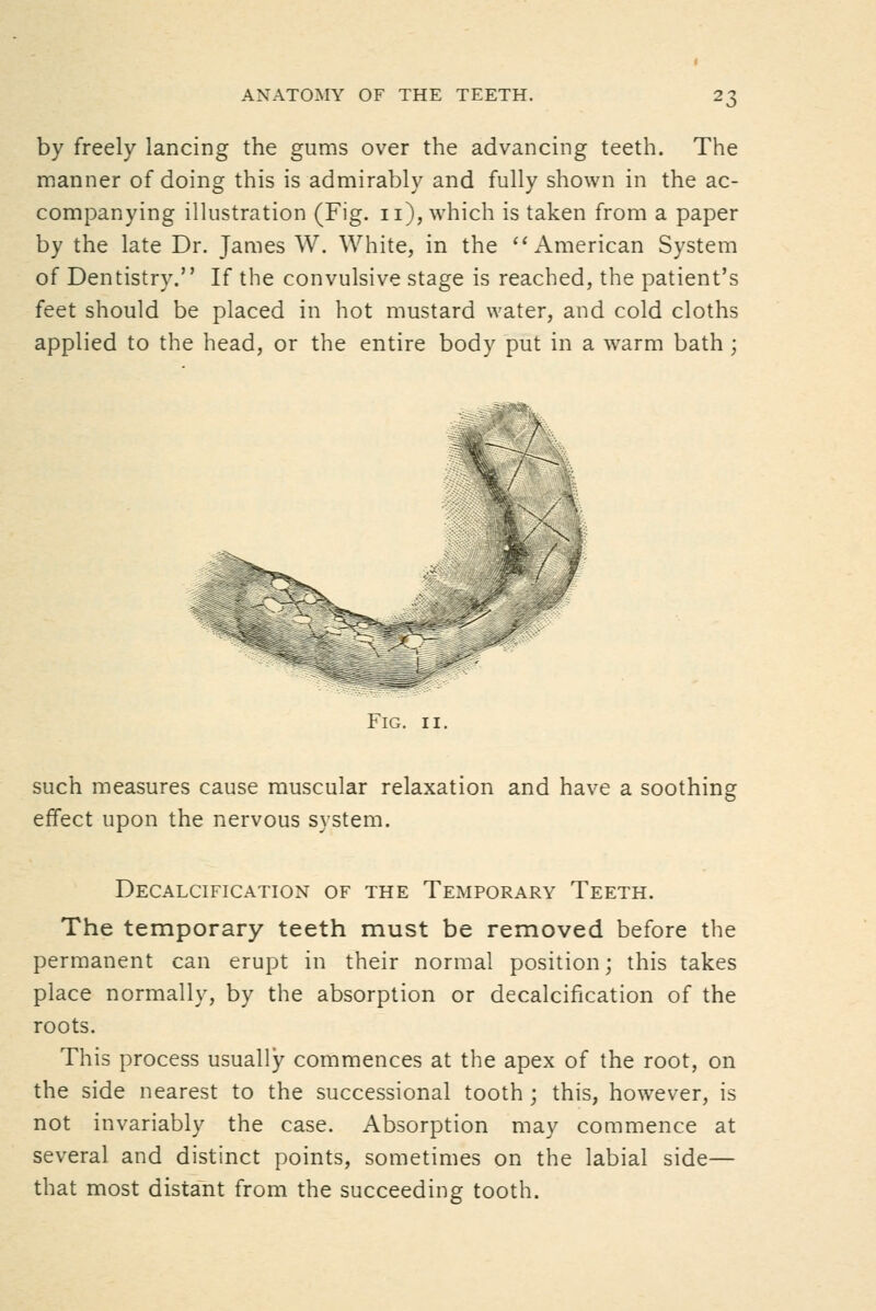 by freely lancing the gums over the advancing teeth. The manner of doing this is admirably and fully shown in the ac- companying illustration (Fig. ii), which is taken from a paper by the late Dr. James W. White, in the ''American System of Dentistry. If the convulsive stage is reached, the patient's feet should be placed in hot mustard water, and cold cloths applied to the head, or the entire body put in a warm bath; Fig. II. such measures cause muscular relaxation and have a soothing effect upon the nervous system. Decalcification of the Temporary Teeth. The temporary teeth must be removed before the permanent can erupt in their normal position; this takes place normally, by the absorption or decalcification of the roots. This process usually commences at the apex of the root, on the side nearest to the successional tooth ; this, however, is not invariably the case. Absorption may coaimence at several and distinct points, sometimes on the labial side— that most distant from the succeeding tooth.