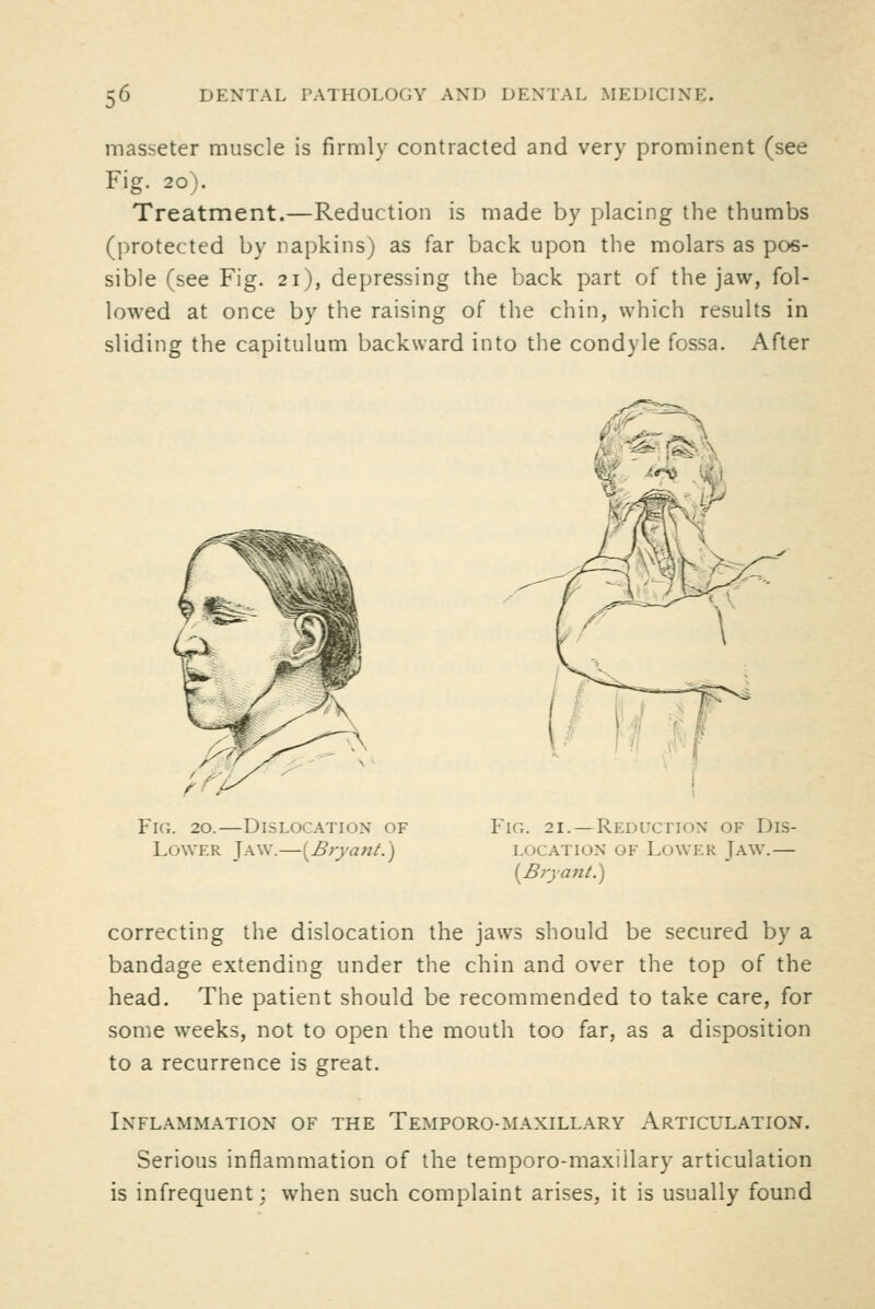 masseter muscle is firmly contracted and very prominent (see Fig. 20). Treatment.—Reduction is made by placing the thumbs (protected by napkins) as far back upon the molars as pos- sible (see Fig. 21), depressing the back part of the jaw, fol- lowed at once by the raising of the chin, which results in sliding the capitulum backward into the condyle fossa. After Fig. 20.—Dislocation of Lower Jaw.—[Bryant.) Fig. 21.—Reduction of Dis- location OF Lower Jaw.— [Brya}ii.) correcting the dislocation the jaws should be secured by a bandage extending under the chin and over the top of the head. The patient should be recommended to take care, for some weeks, not to open the mouth too far, as a disposition to a recurrence is great. Inflammation of the Temporo-maxillary Articulation. Serious inflammation of the temporo-maxillary articulation is infrequent; when such complaint arises, it is usually found