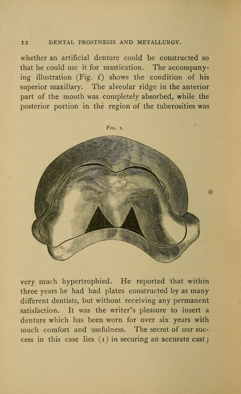 whether an artificial denture could be constructed so that he could use it for mastication. The accompany- ing illustration (Fig. i) shows the condition of his superior maxillary. The alveolar ridge in the anterior part of the mouth was completely absorbed, while the posterior portion in the region of the tuberosities was Fig. i. very much hypertrophied. He reported that within three years he had had plates constructed by as many different dentists, but without receiving any permanent satisfaction. It was the writer's pleasure to insert a denture which has been worn for over six years with much comfort and usefulness. The secret of our suc- cess in this case lies (i) in securing an accurate cast;