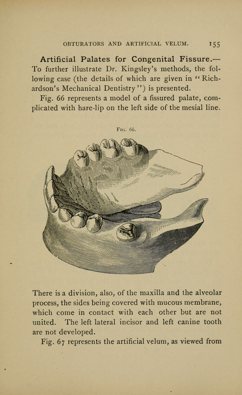 Artificial Palates for Congenital Fissure.— To further illustrate Dr. Kingsley's methods, the fol- lowing case (the details of which are given in  Rich- ardson's Mechanical Dentistry) is presented. Fig. 66 represents a model of a fissured palate, com- plicated with hare-lip on the left side of the mesial line. Fig. 66. There is a division, also, of the maxilla and the alveolar process, the sides being covered with mucous membrane, which come in contact with each other but are not united. The left lateral incisor and left canine tooth are not developed. Fig. 67 represents the artificial velum, as viewed from