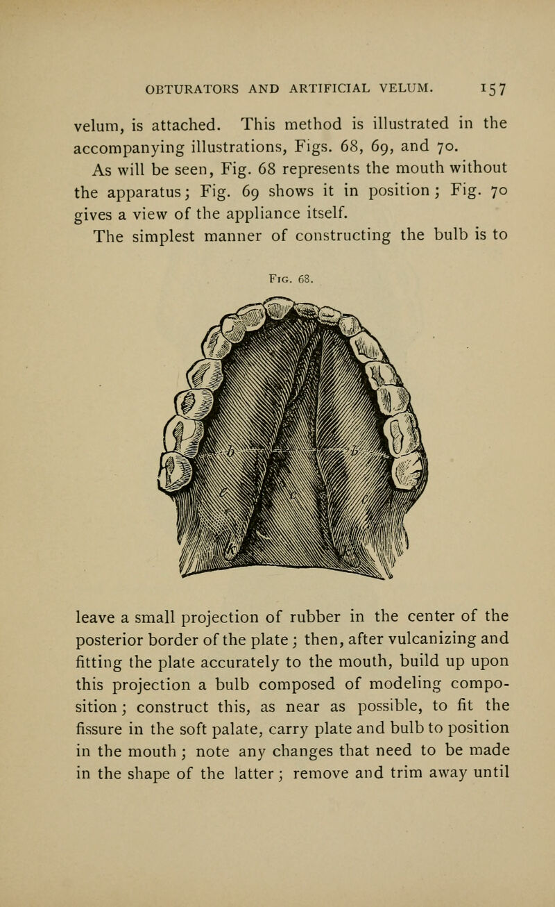 velum, is attached. This method is illustrated in the accompanying illustrations, Figs. 68, 69, and 70. As will be seen, Fig. 68 represents the mouth without the apparatus; Fig. 69 shows it in position ; Fig. 70 gives a view of the appliance itself. The simplest manner of constructing the bulb is to Fig. 68. leave a small projection of rubber in the center of the posterior border of the plate ; then, after vulcanizing and fitting the plate accurately to the mouth, build up upon this projection a bulb composed of modeling compo- sition ; construct this, as near as possible, to fit the fissure in the soft palate, carry plate and bulb to position in the mouth; note any changes that need to be made in the shape of the latter; remove and trim away until