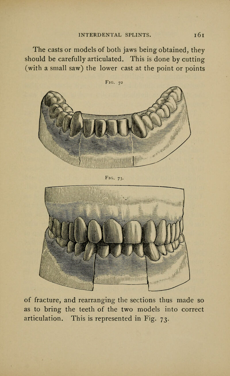 The casts or models of both jaws being obtained, they should be carefully articulated. This is done by cutting (with a small saw) the lower cast at the point or points Fig. 72 Fig. 73. of fracture, and rearranging the sections thus made so as to bring the teeth of the two models into correct articulation. This is represented in Fig. 73.
