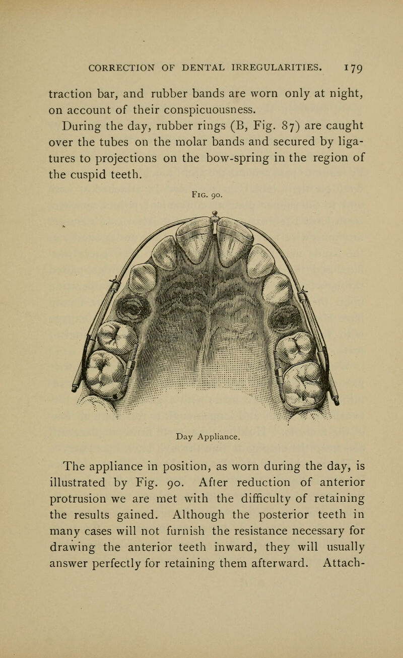 traction bar, and rubber bands are worn only at night, on account of their conspicuousness. During the day, rubber rings (B, Fig. 87) are caught over the tubes on the molar bands and secured by liga- tures to projections on the bow-spring in the region of the cuspid teeth. Fig. 90. Day Appliance. The appliance in position, as worn during the day, is illustrated by Fig. 90. After reduction of anterior protrusion we are met with the difficulty of retaining the results gained. Although the posterior teeth in many cases will not furnish the resistance necessary for drawing the anterior teeth inward, they will usually answer perfectly for retaining them afterward. Attach-