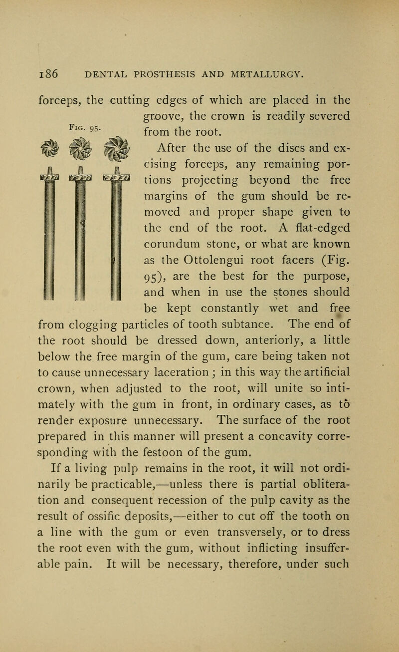 Fig. 95- forceps, the cutting edges of which are placed in the groove, the crown is readily severed from the root. After the use of the discs and ex- cising forceps, any remaining por- tions projecting beyond the free margins of the gum should be re- moved and proper shape given to the end of the root. A flat-edged corundum stone, or what are known as the Ottolengui root facers (Fig. 95), are the best for the purpose, and when in use the stones should be kept constantly wet and free from clogging particles of tooth subtance. The end of the root should be dressed down, anteriorly, a little below the free margin of the gum, care being taken not to cause unnecessary laceration ; in this way the artificial crown, when adjusted to the root, will unite so inti- mately with the gum in front, in ordinary cases, as to render exposure unnecessary. The surface of the root prepared in this manner will present a concavity corre- sponding with the festoon of the gum. If a living pulp remains in the root, it will not ordi- narily be practicable,—unless there is partial oblitera- tion and consequent recession of the pulp cavity as the result of ossific deposits,—either to cut off the tooth on a line with the gum or even transversely, or to dress the root even with the gum, without inflicting insuffer- able pain. It will be necessary, therefore, under such