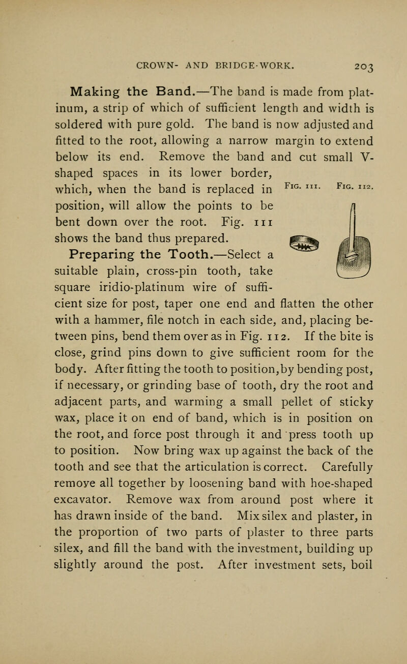 Making the Band.—The band is made from plat- inum, a strip of which of sufficient length and width is soldered with pure gold. The band is now adjusted and fitted to the root, allowing a narrow margin to extend below its end. Remove the band and cut small V- shaped spaces in its lower border, which, when the band is replaced in FlG- *■ FlG- II2- position, will allow the points to be bent down over the root. Fig. in shows the band thus prepared. pc^fe Preparing the Tooth.—Select a suitable plain, cross-pin tooth, take square iridio-platinum wire of suffi- cient size for post, taper one end and flatten the other with a hammer, file notch in each side, and, placing be- tween pins, bend them over as in Fig. 112. If the bite is close, grind pins down to give sufficient room for the body. After fitting the tooth to position,by bending post, if necessary, or grinding base of tooth, dry the root and adjacent parts, and warming a small pellet of sticky wax, place it on end of band, which is in position on the root, and force post through it and press tooth up to position. Now bring wax up against the back of the tooth and see that the articulation is correct. Carefully remoye all together by loosening band with hoe-shaped excavator. Remove wax from around post where it has drawn inside of the band. Mixsilex and plaster, in the proportion of two parts of plaster to three parts silex, and fill the band with the investment, building up slightly around the post. After investment sets, boil