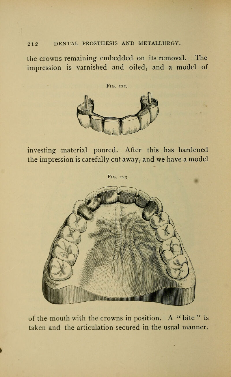 the crowns remaining embedded on its removal. The impression is varnished and oiled, and a model of Fig. 122. investing material poured. After this has hardened the impression is carefully cut away, and we have a model Fig. 123. of the mouth with the crowns in position. A  bite  is taken and the articulation secured in the usual manner.